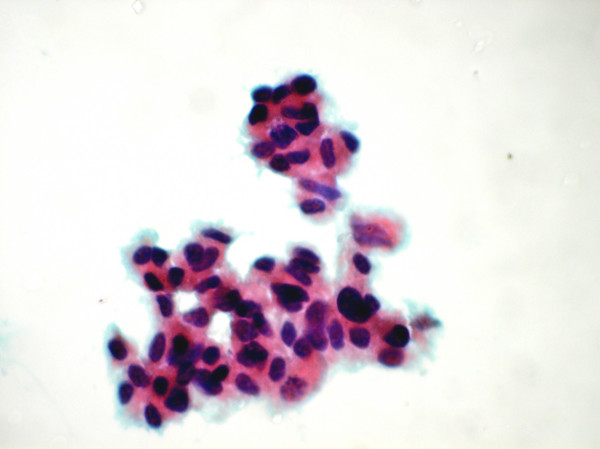 Cluster of malignant atypical cell showing nuclear pleomorphism (Papanicolaou's stain ×1375).