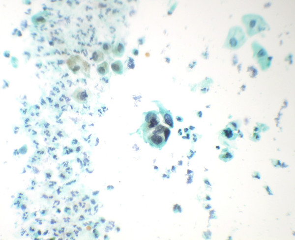 Smear shows tiny cluster of malignant atypical cells. (Papanicolaou's stain × 550).