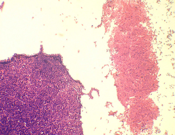 A large cell cluster of cells show necrosis. Part of a viable cluster is also identified (Papanicolaou's stain × 280).