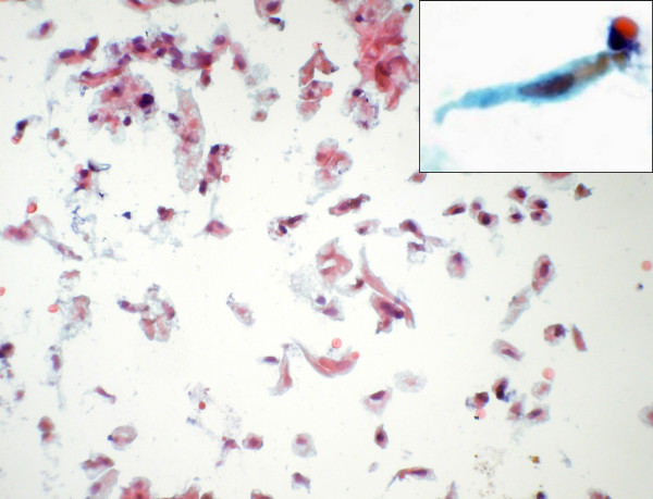 Singly scattered spindle cells seen in some of the smears (Papanicolaou stain × 280). Inset shows a high power view of the same