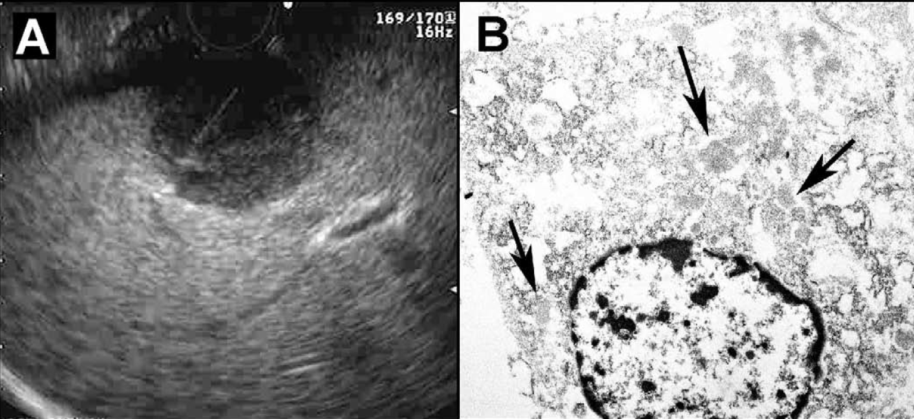 A. Endoscopic ultrasound showing the metastatic mass in the left lobe of liver with an aspirating fine needle in it. B. Electron micrograph showing clusters of spherical shape and homogenous, medium electron dense zymogen granules in the cytoplasm (arrows).