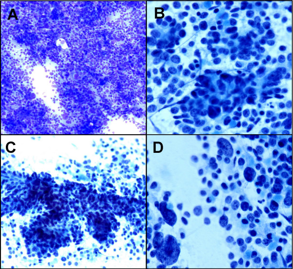 A. Hypercellular aspirate with sheet of pleomorphic tumor cells (Diff-Quik, ×10) B. Vaguely acinar formation (Papanicolaou stain ×20). C. Trabecular pattern (Papanicolaou stain ×10). D. Scattered large tumor cells with giant nuclei (Papanicolaou stain ×20).