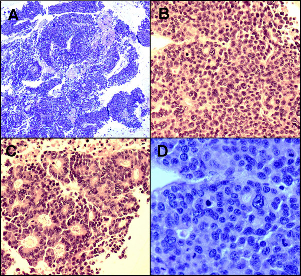 A. On cell block, the tumor cells arranged in thick trabeculae, poorly formed glands or acini. Necrosis is evident. (H&E stain ×4); B. Solid pattern. (H&E stain ×20); C. Acinar pattern with uniform, eccentric located nuclei with abundant eosinophilic cytoplasm. (H&E stain ×20); D. Tumor cells with pleomorphic, centrally located nuclei, small to prominent nucleoli and scant to moderate amount of cytoplasm. Brisk and abnormal mitosis are evident. (H&E stain ×40)