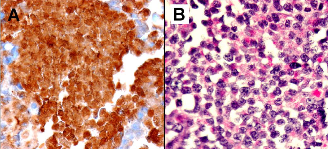 A. The tumor cells are strongly positive for alpha-antitrypsin (immunoperoxidase stain ×40) B. Tumor cells with positive cytoplasmic PAS-D stain. (Periodic Acid-Schif with diastase stain ×40)