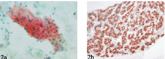 Parathyroid hormone (PTH) immunostaining performed on a destained Pap smear (A) and cell block (B) showing distinct cytoplasmic positivity.