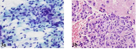 FNAB smear (A) and core biopsy (B) specimens from a case of metastatic parathyroid carcinoma in the liver showing sheets of relatively bland spindle and round cells.