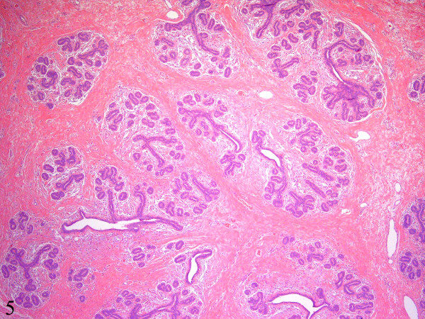 There are multiple large lobules displaying increased numbers of ductules and acini. The intralobular and interlobular stroma consists of dense collagenous fibrosis that is predominantly bland and relatively acellular (Hematoxylin-eosin, ×40).