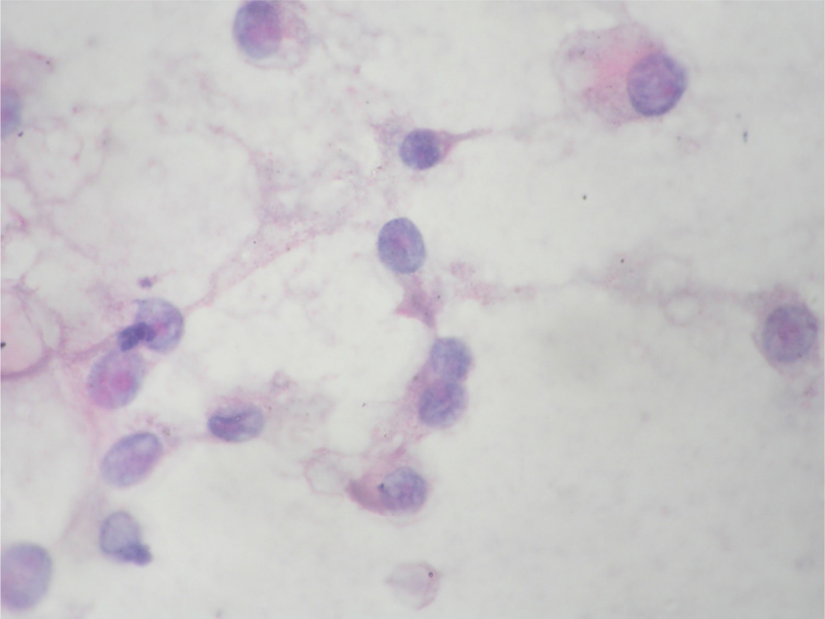 Discrete cells showing abundant granular cytoplasm with vacuolation.Papanicolaou stain × 1000.