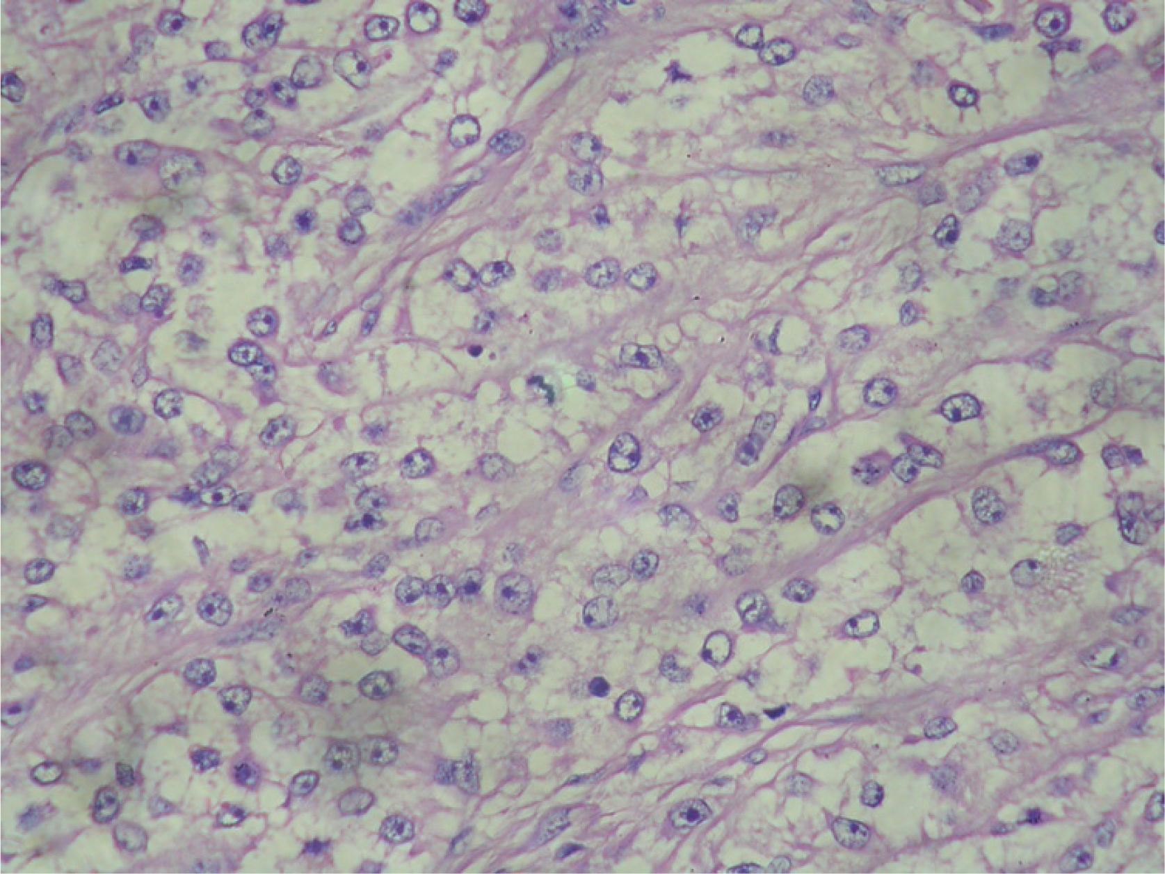 Thin fibrous septa dividing cells arranged in a nesting/alveolar pattern with prominent nucleolus and clear cytoplasm. Hematoxylin and Eosin × 400.