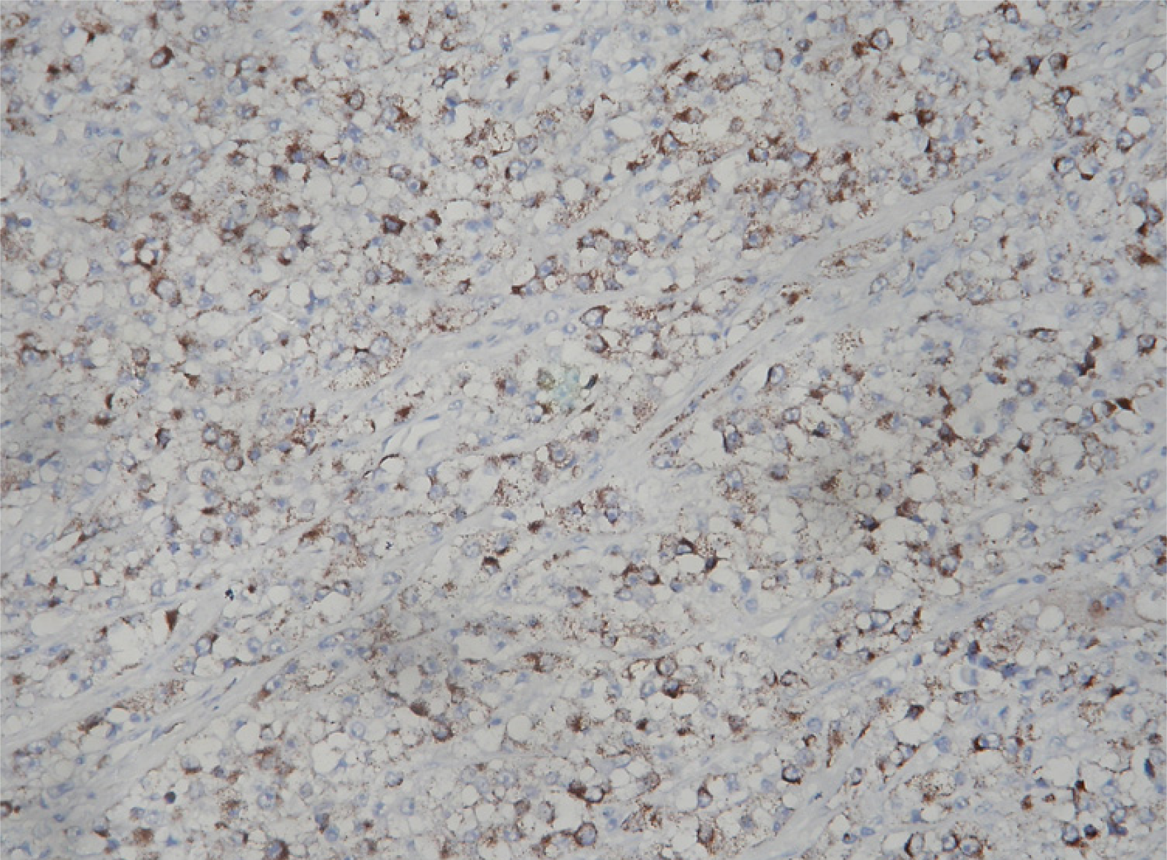 Immunohistochemistry with HMB 45 showed the tumor cells exhibiting cytoplasmic positivity. IHC – Streptavidin Biotin × 200.