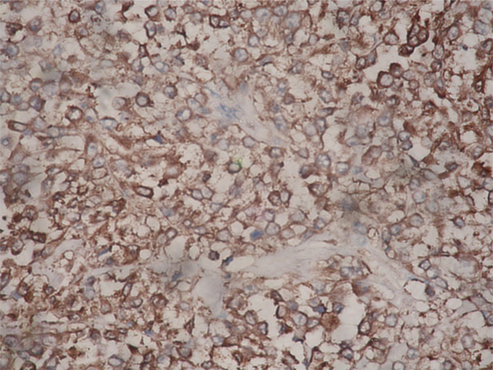 The tumor cells expressed a strong positivity for Neuron specific Enolase (NSE). IHC – Streptavidin Biotin × 400.