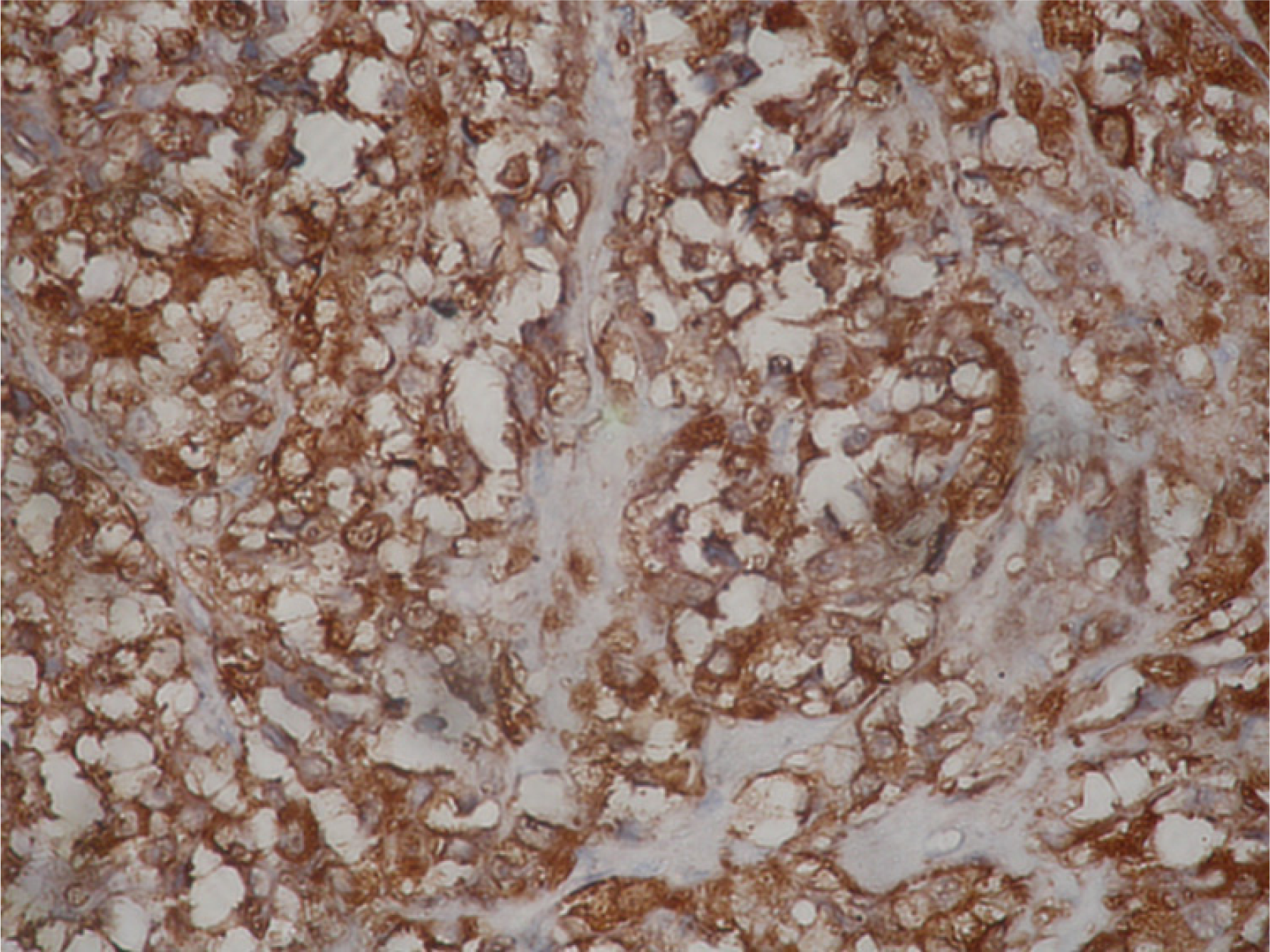 The tumor cells also were positive for S100. IHC – Streptavidin Biotin × 400.