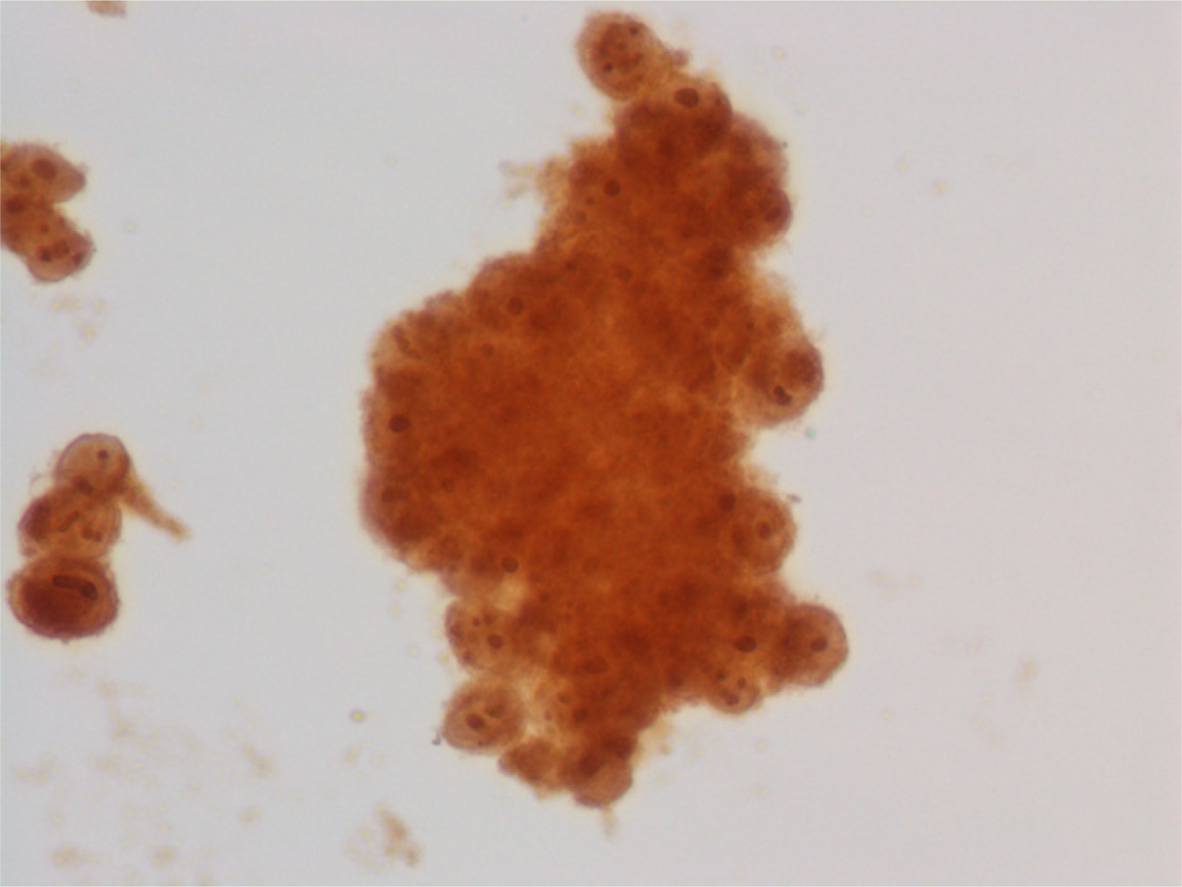 Thin layer preparation, vaginal melanoma: immunocytochemical stain for HMB 45 showing diffuse cytoplasmic positivity in neoplastic cells.