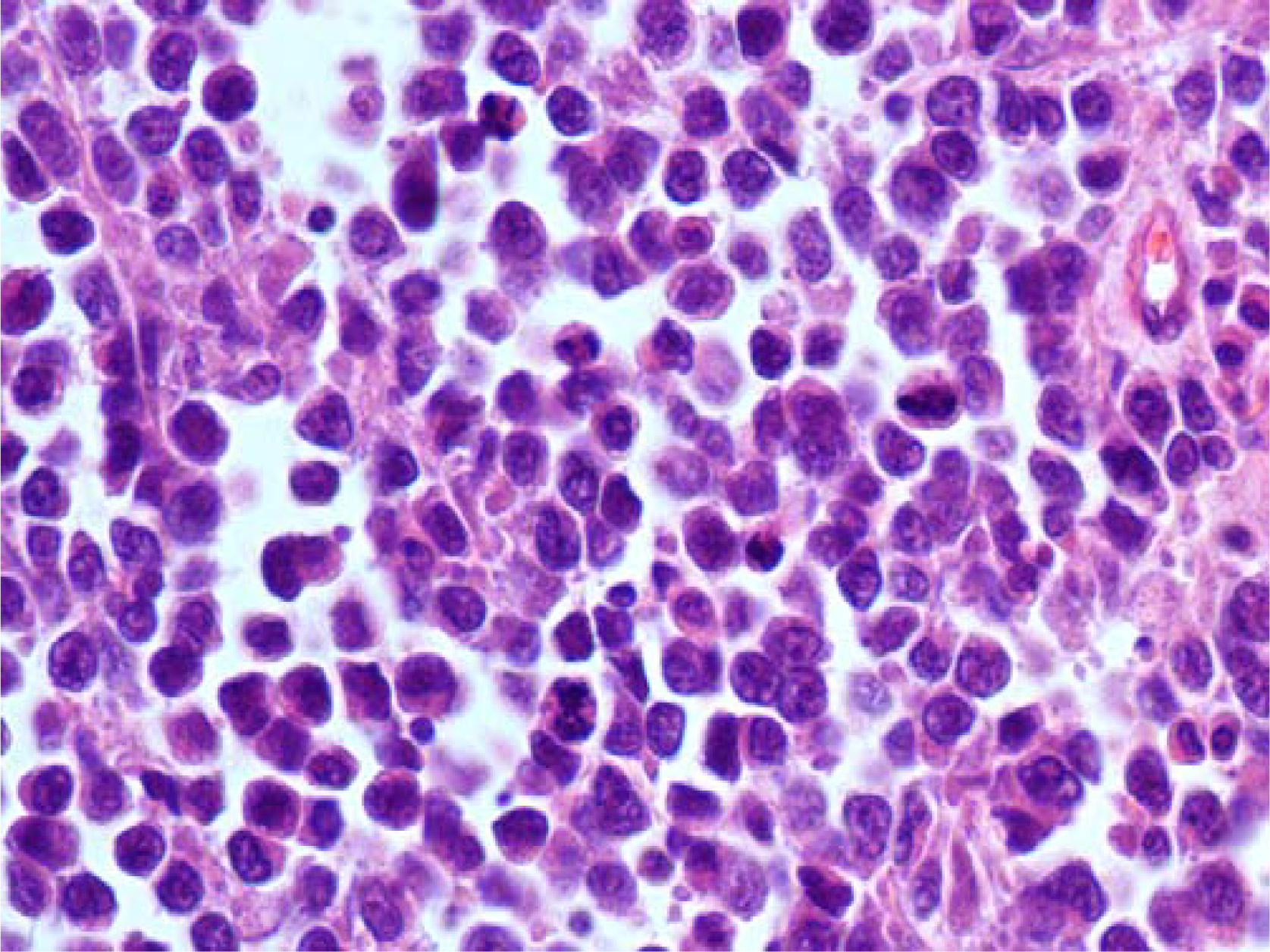 Vaginal melanoma: histopathological section showing an infiltrating dispersed cell population with alveolar pattern of growth (Hematoxylin and Eosin, 250×, original magnification).