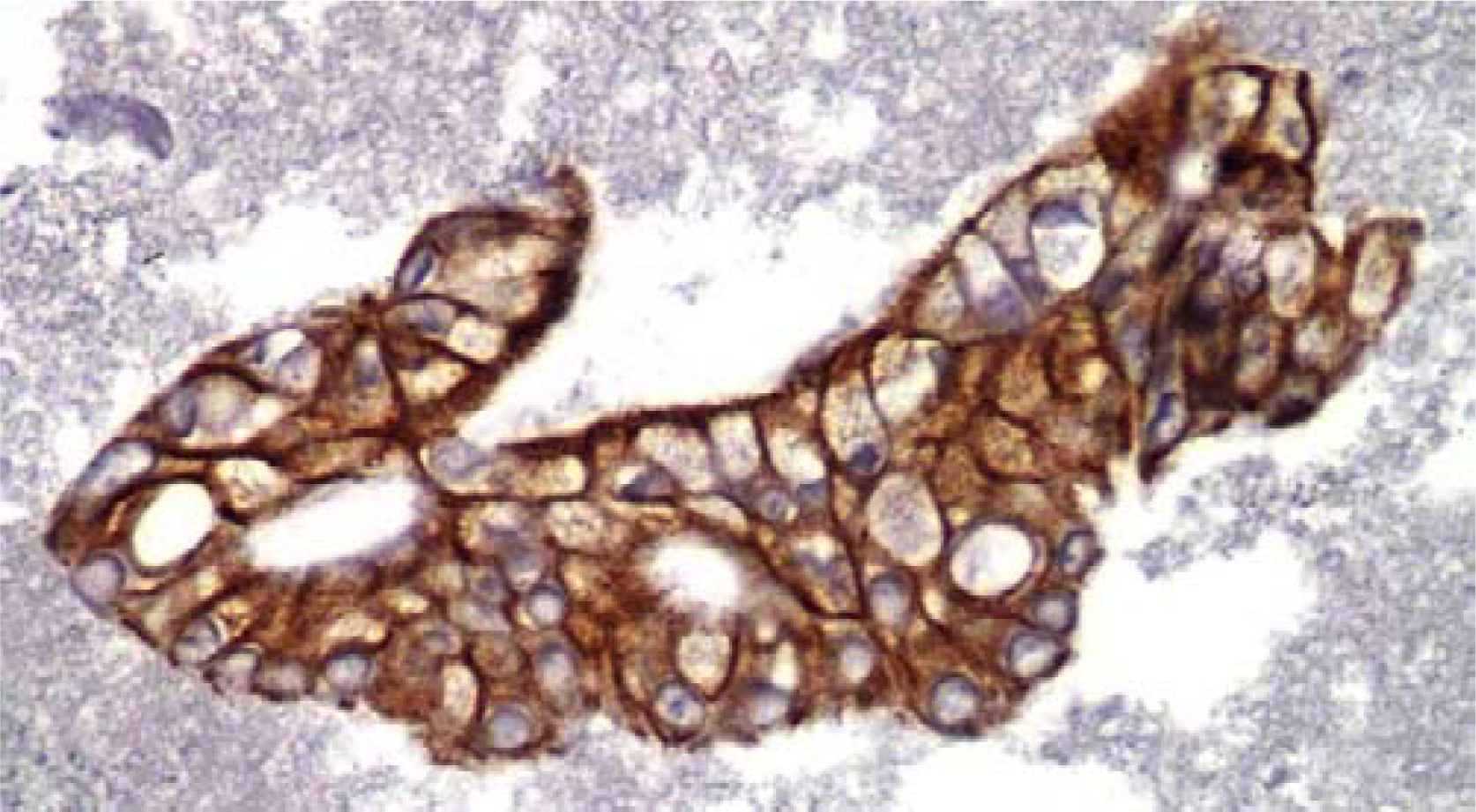Representative fragment of Pancreatic Adenocarcinoma stained with CK19 (IHC, 40×).