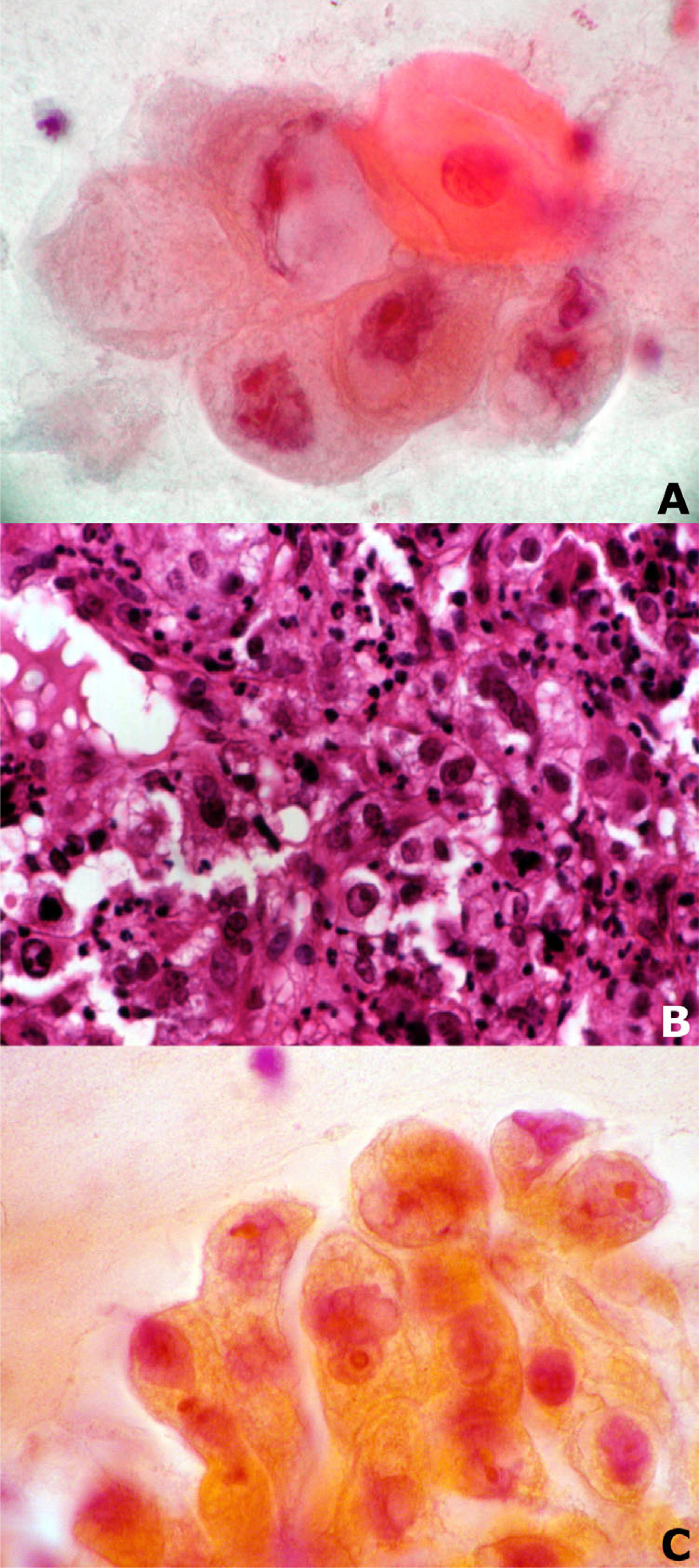 Bronchial aspirate before biopsy (A), biopsy specimen (B) and bronchial washing after biopsy (C) in a case of NSCLC, large cell carcinoma type (Papanicolaou stain, ×630 (A and C), Haematoxylin and Eosin stain × 200 (B)).