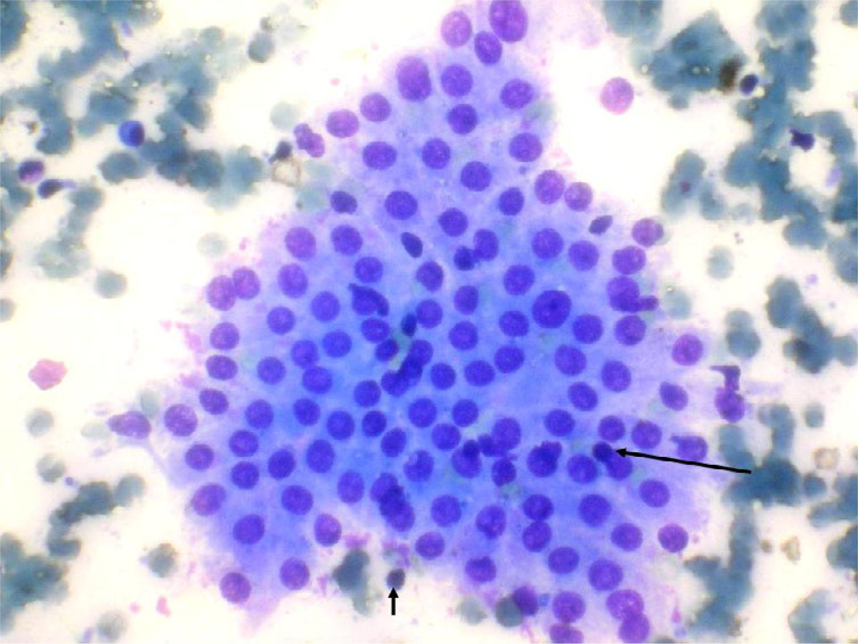 Grade I thyroiditis with mild lymphocytic inflammatory infiltrate (arrows) (May Grünwald Giemsa).