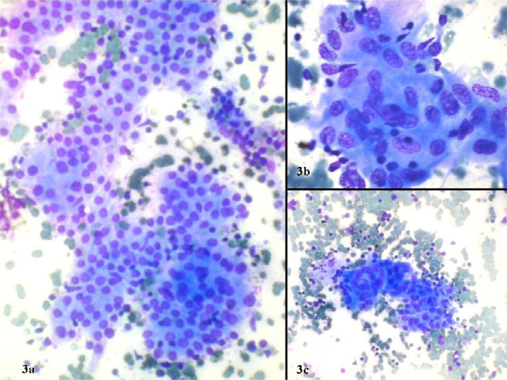 Grade II thyroiditis with a) moderate lymphocytic inflammation b) epithelioid cell granuloma c) multinucleated giant cell (May Grünwald Giemsa).