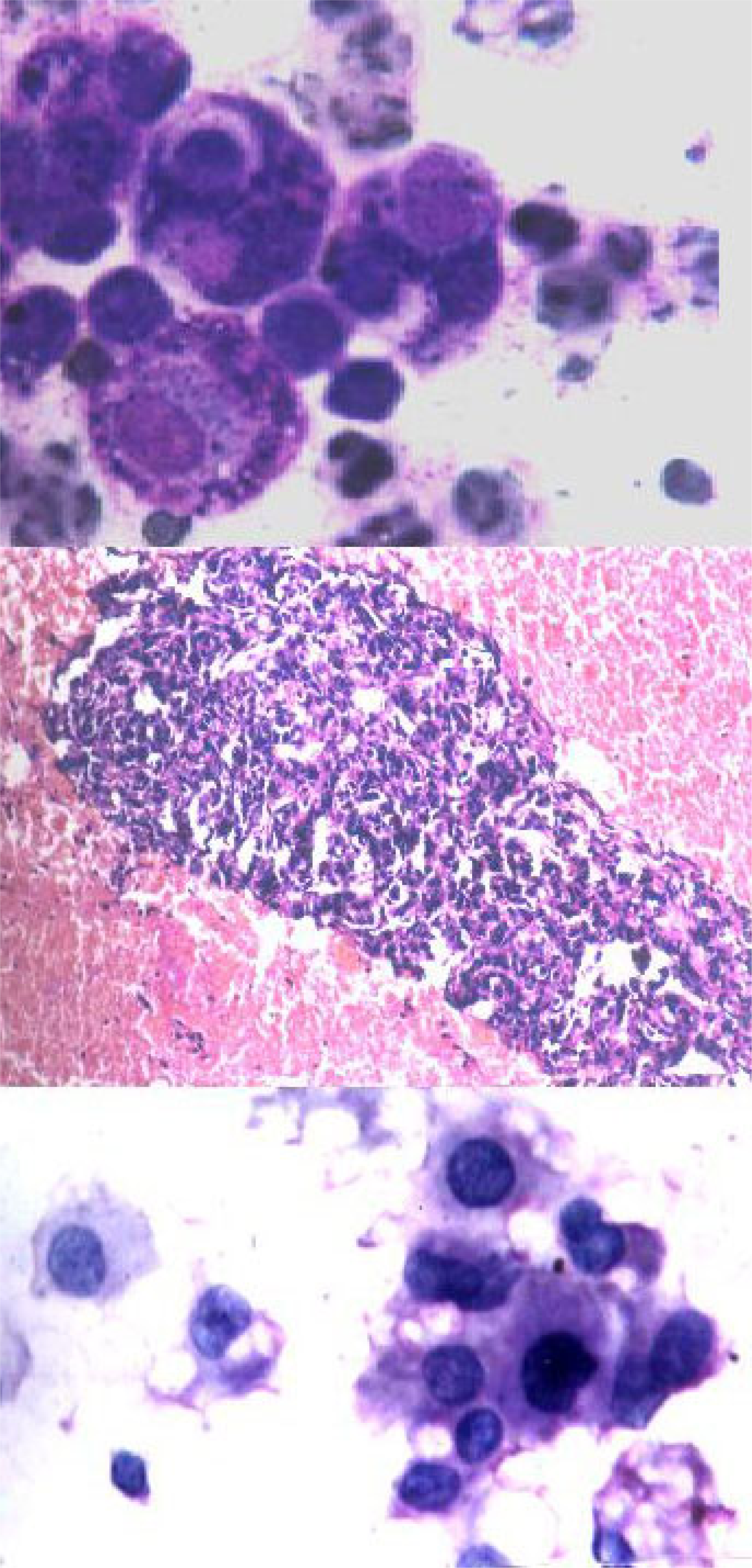 1. Cells showing coarse purplish granules in the cytoplasm [MGG; ×1000]. 2. Plasmacytoid tumor cells. [H&E; ×1000]. 3. Cell block preparation of osteosarcoma: [H&E; ×200].