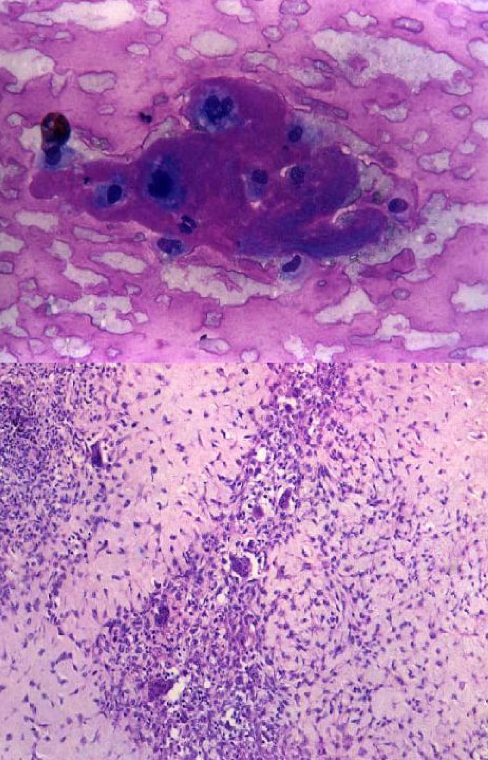 1. Chondroblast like cells embedded in chondroid fragment in a myxoid background. [MGG; ×400].