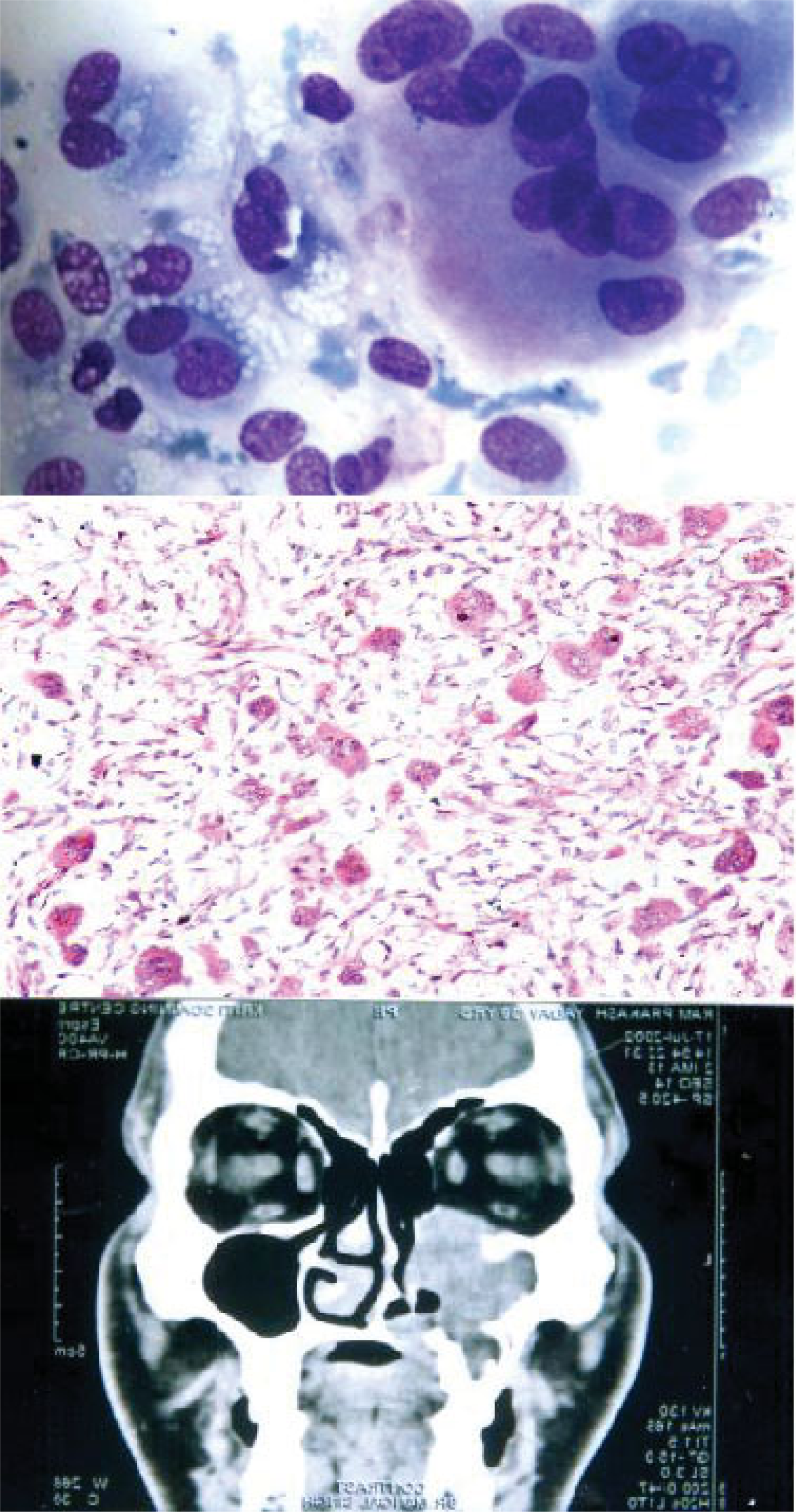 1. Giant cell tumor like picture of giant cell reparative granuloma [MGG; ×400]. 2. Giant cell reparative granuloma: histological picture showing giant cells lying in loose stroma. [H&E ×200]. 3. CT scan of giant cell reparative granuloma showing a mass in right maxillary sinus with extension into the adjacent areas.