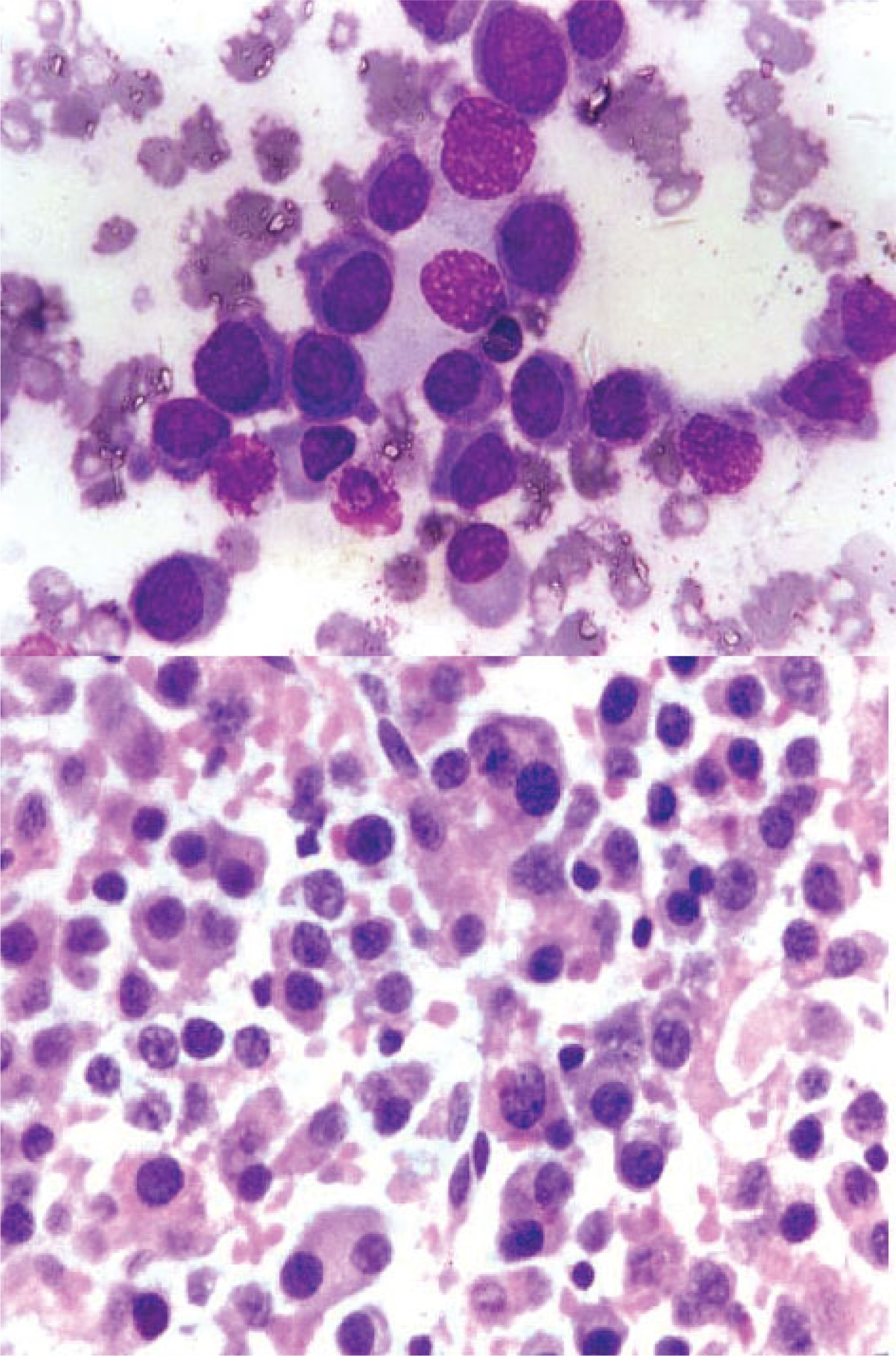 1. Smear showing myeloma cells. [MGG; × 400]. 2. Histopathology section showing dispersed tumor cells many having a “clock-face” condensation of chromatin. [H&E × 200].