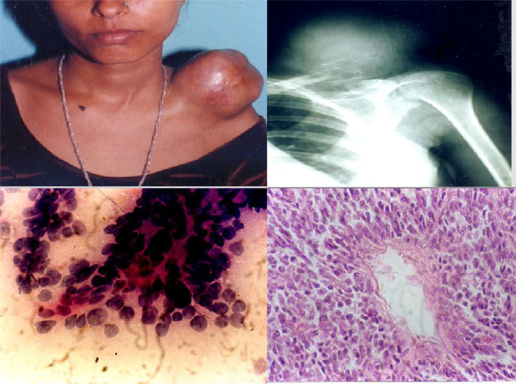 1. Photograph of a patient showing swelling over left shoulder: later diagnosed as Hemangiopericytoma. 2. X-ray showing lesion involving the left clavicle. 3. Smear showing malignant round cells radiating from vessels. [MGG ×400]. 4. Histological section of the same case showing monomorphic round cells radiating from cells [H&E × 200].