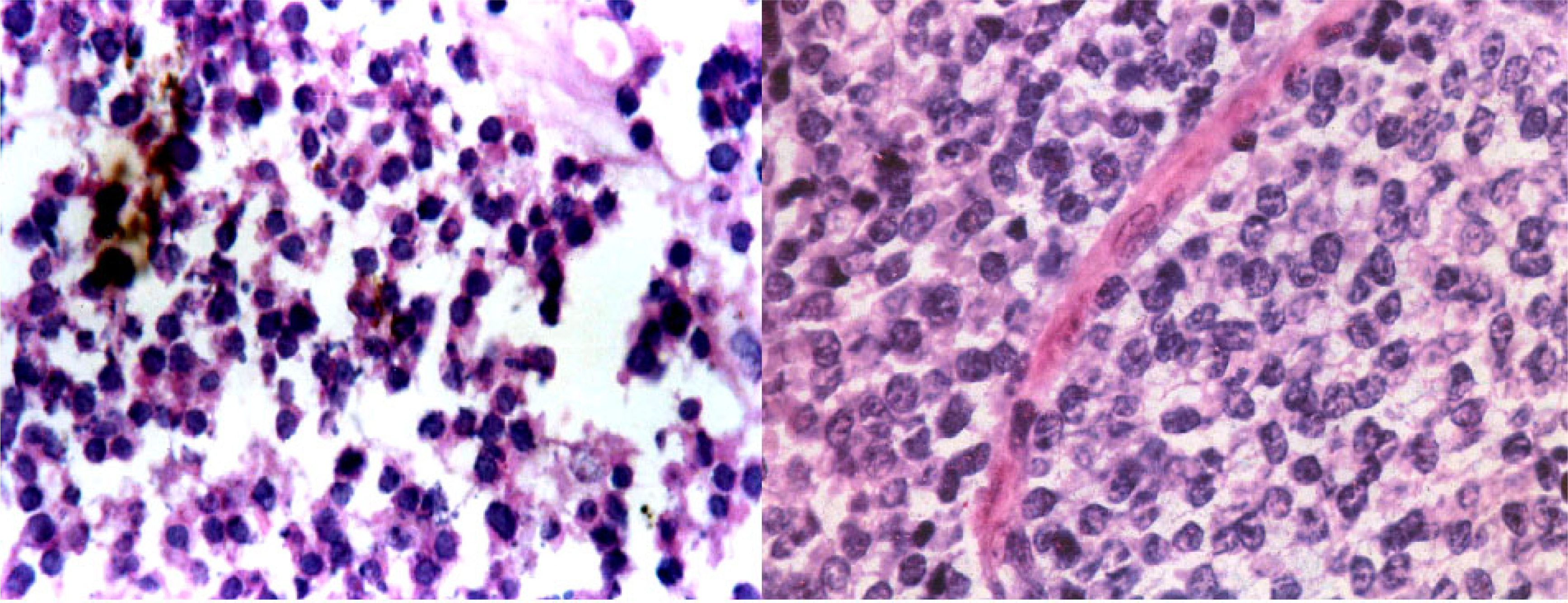 1. Cytology of Ewing's sarcoma. [MGG ×200]. 2. Histology of the same.