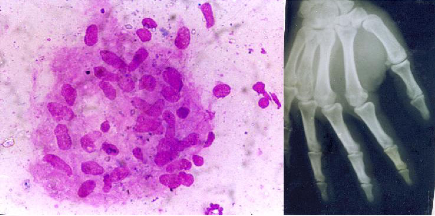1. Epithelioid granuloma of tubercular osteomyelitis. [MGG ×400]. 2. X ray right hand from a case of tubercular osteomyelitis involving distal portion of 4th metacarpal.