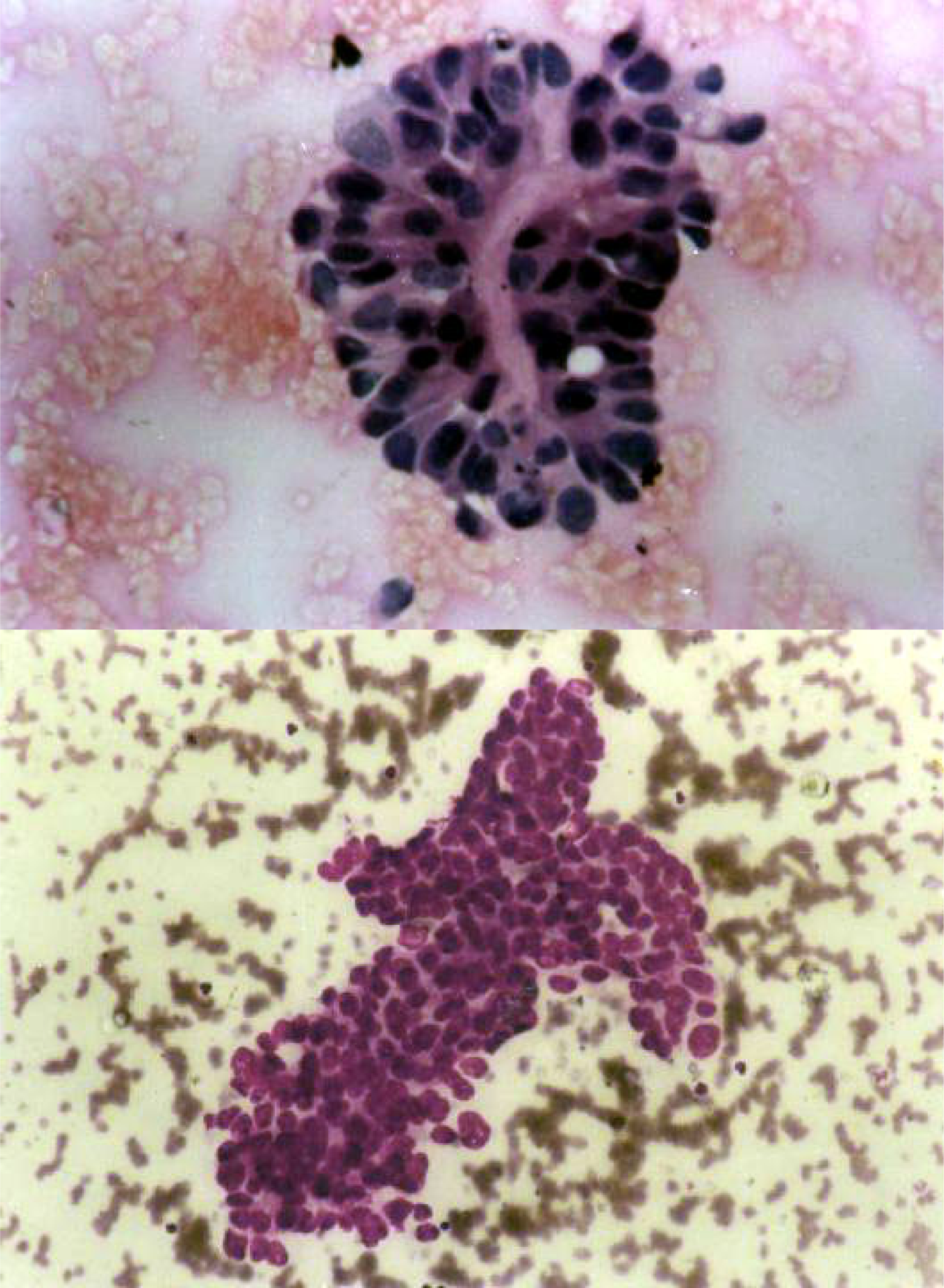 1. Metastatic adenocarcinoma: Tumors cell arranged in a glandular pattern [MGG ×400]. 2. Metastatic adenocarcinoma: Tumors cell arranged in an acinar pattern. [MGG ×400].