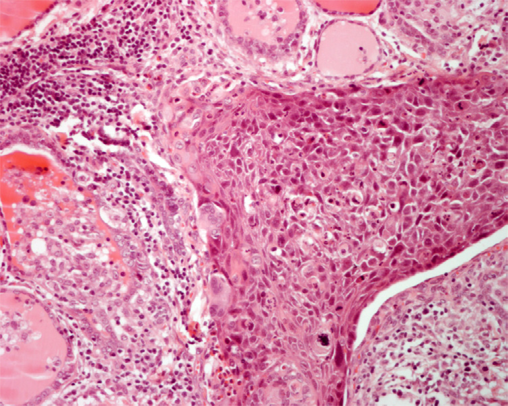 Histology of a moderately differentiated squamous cell carcinoma metastatic to the thyroid in patient 1. Residual thyroid follicles are present elsewhere (hematoxylin and eosin, × 250).