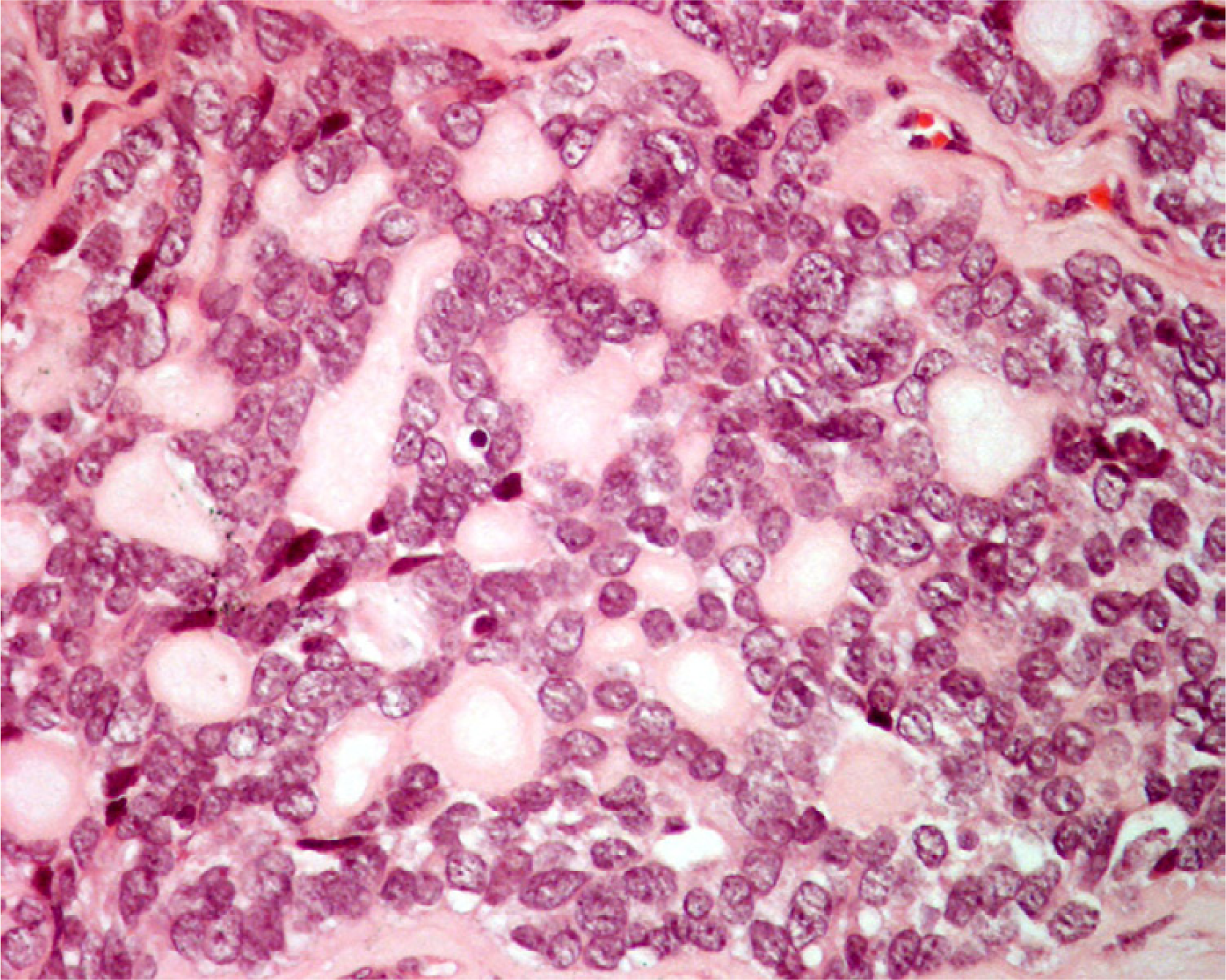 Histology of an adenoid cystic carcinoma metastatic to the thyroid in patient 2 shows small cells surrounding round spaces containing pale, slightly basophilic material (hematoxylin and eosin, × 250).