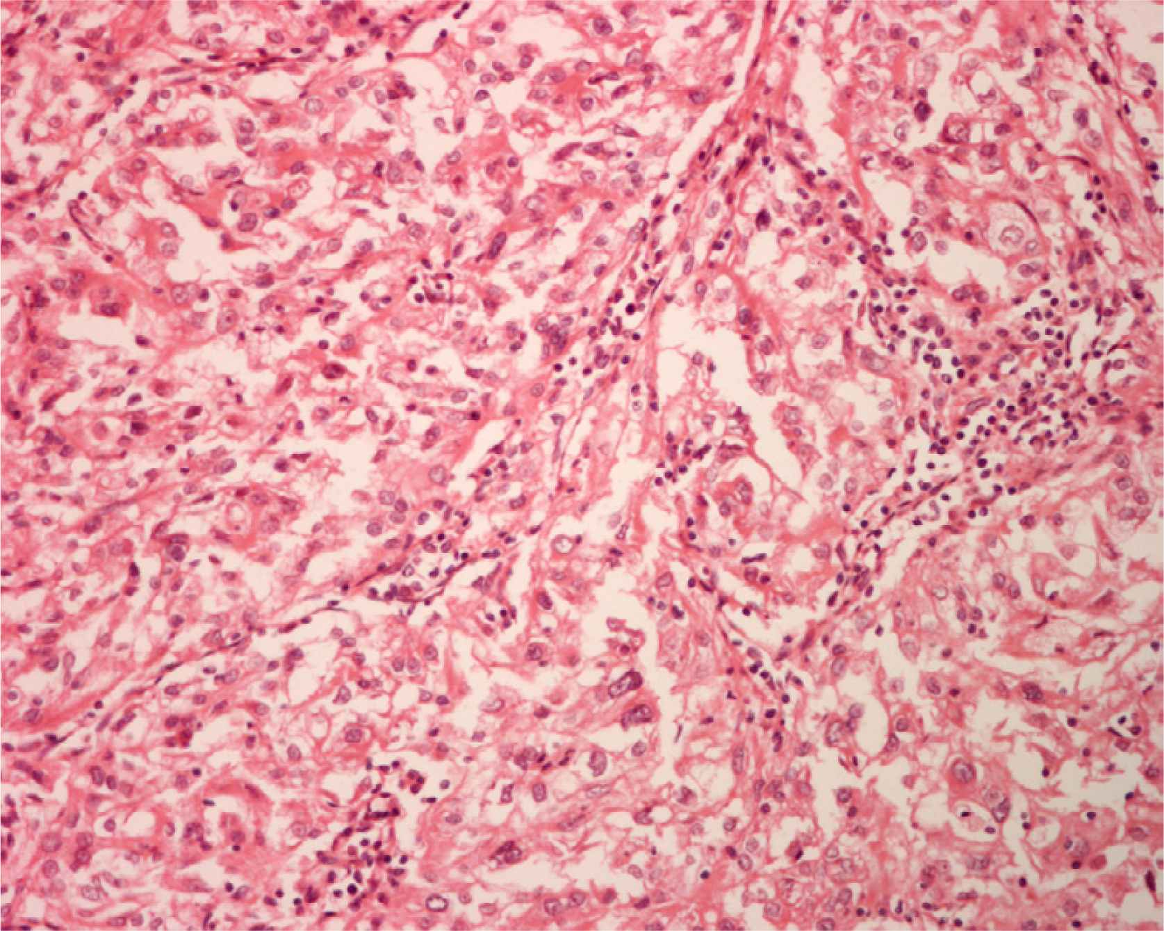 Histology of a renal cell carcinoma, clear cell type, metastatic to the thyroid in patient 3 shows tumor cells with granular cytoplasm, oval nuclei and conspicuous nucleoli arranged in glandular pattern (hematoxylin and eosin, × 250).