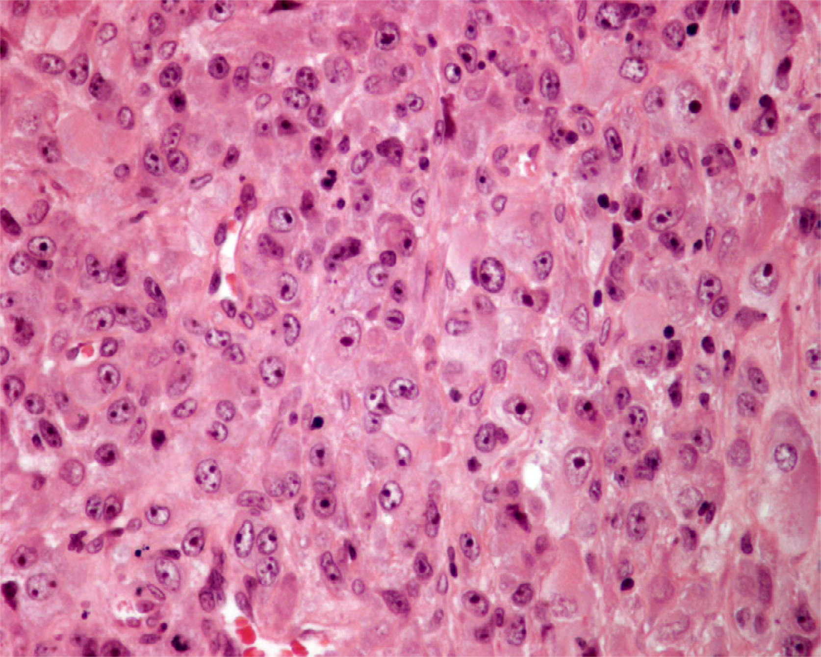 Histology of metastatic amelanotic melanoma to the thyroid in patient 4 shows large malignant polygonal cells with oval nuclei and prominent nucleoli, in solid pattern (hematoxylin and eosin, × 250).
