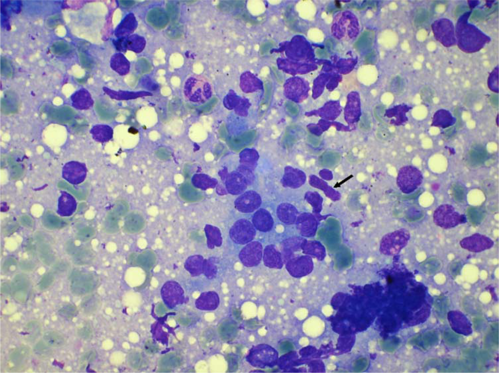 Myoepithelial cells in cytology smear of carcinoma in situ. (May Grunwald Giemsa stain × 480).