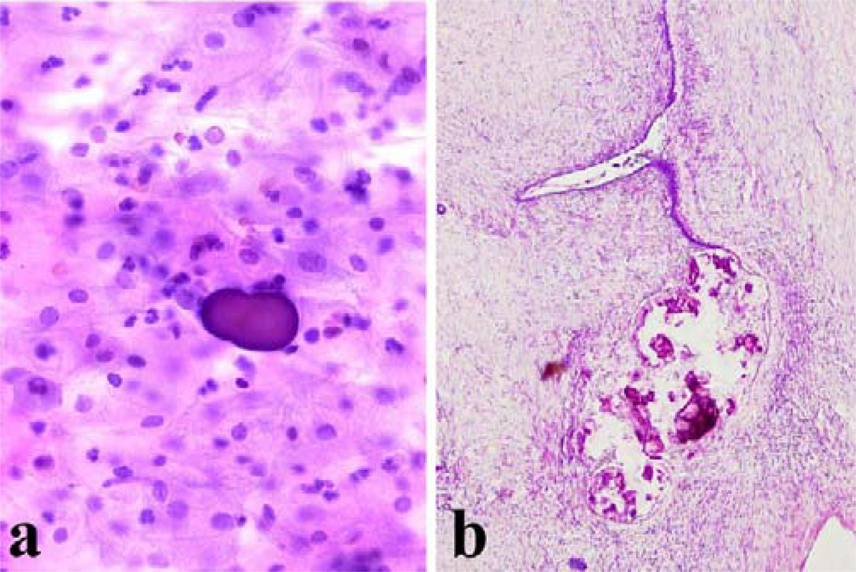 a) Presence of a psammoma body in absence of atypical cells in cervicovaginal smear (Papanicolaou stain, 200×); b) Serous ovarian cystoadenofibroma with parietal psammoma bodies (Hematoxylin and Eosin, 100×)