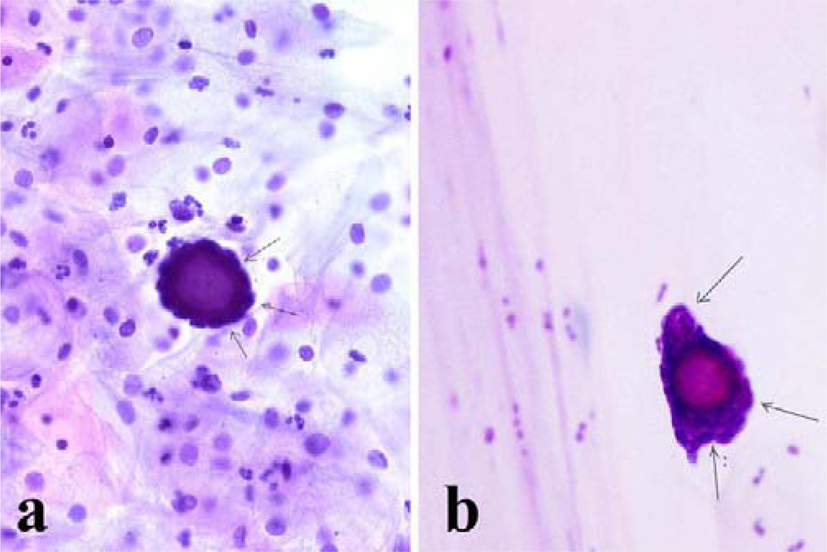 a) Psammoma body surrounded by atypical cells (arrows) in cervicovaginal smear (Papanicolaou stain, 200×); b) Psammoma body surrounded by atypical cells (arrows) in endometrial aspiration smear (Papanicolaou stain, 200×).