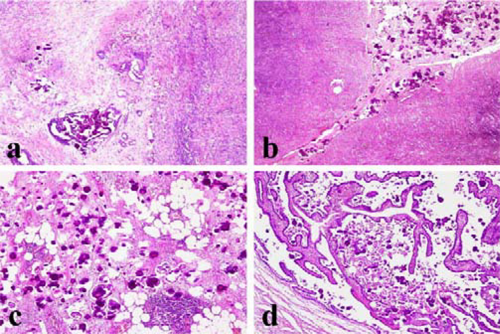 a) Moderately differentiated ovarian adenocarcinoma with psammoma bodies infiltrating the stroma (Hematoxylin and Eosin, 100×); b) Psammocarcinoma localized on the ovarian surface with invasion of the underlying stroma (Hematoxylin and Eosin, 100×); c) Omental metastasis of psammocarcinoma (Hematoxylin and Eosin, 100×); d) Presence of psammocarcinoma in the tubaric lumen (Hematoxylin and Eosin, 100×).