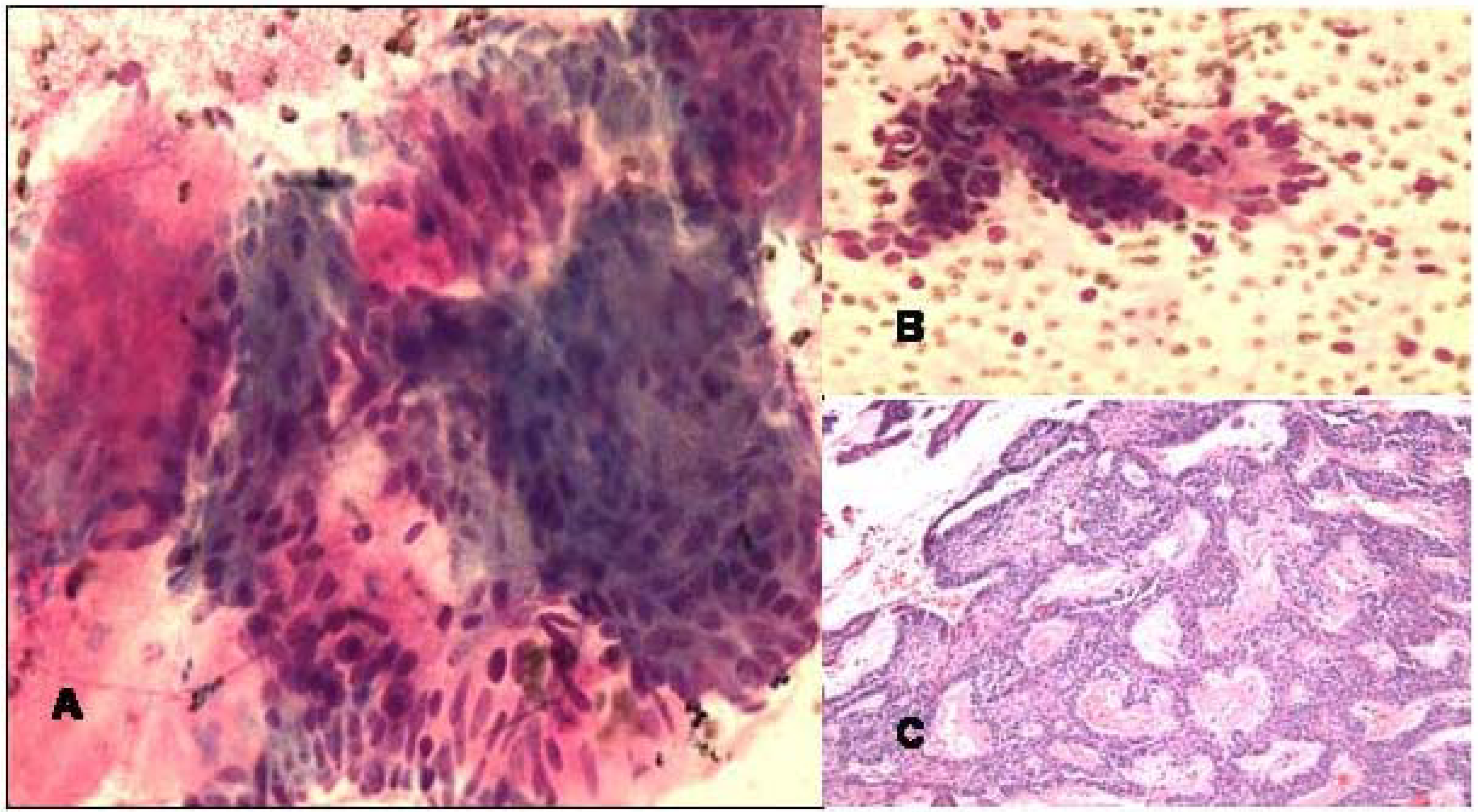 a and b. FNA smears of ameloblastoma of left maxillary sinus showing mixture of palisading groups of epithelial cells with myxoid mesenchymal elements (Diff-Quik, ×400).c. Histologically, the resected mass showed anastomosing islands and cords of basoloid epithelial tumor cells separated by myxoid mesenchymal stroma (Hematoxylin & Eosin, ×100).