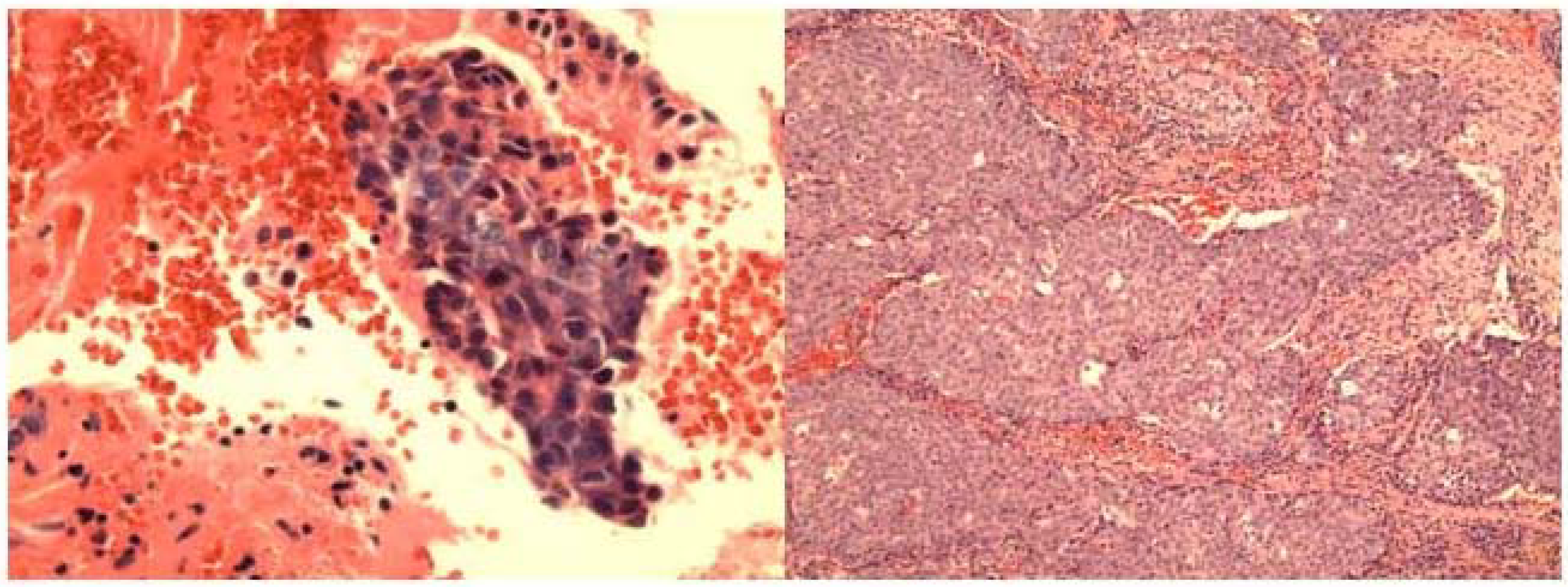 a. Cell block section of FNA of sinonasal undifferentiated carcinoma showing clusters of markedly atypical malignant cells with high nuclear-cytoplasmic ratio, and nuclear hyperchromasia. (Hematoxylin &Eosin, ×400).b. Histologically, the tumor displays infiltrating large irregular nests of malignant cells with surrounding fibrous stroma. (Hematoxylin & Eosin, ×100).