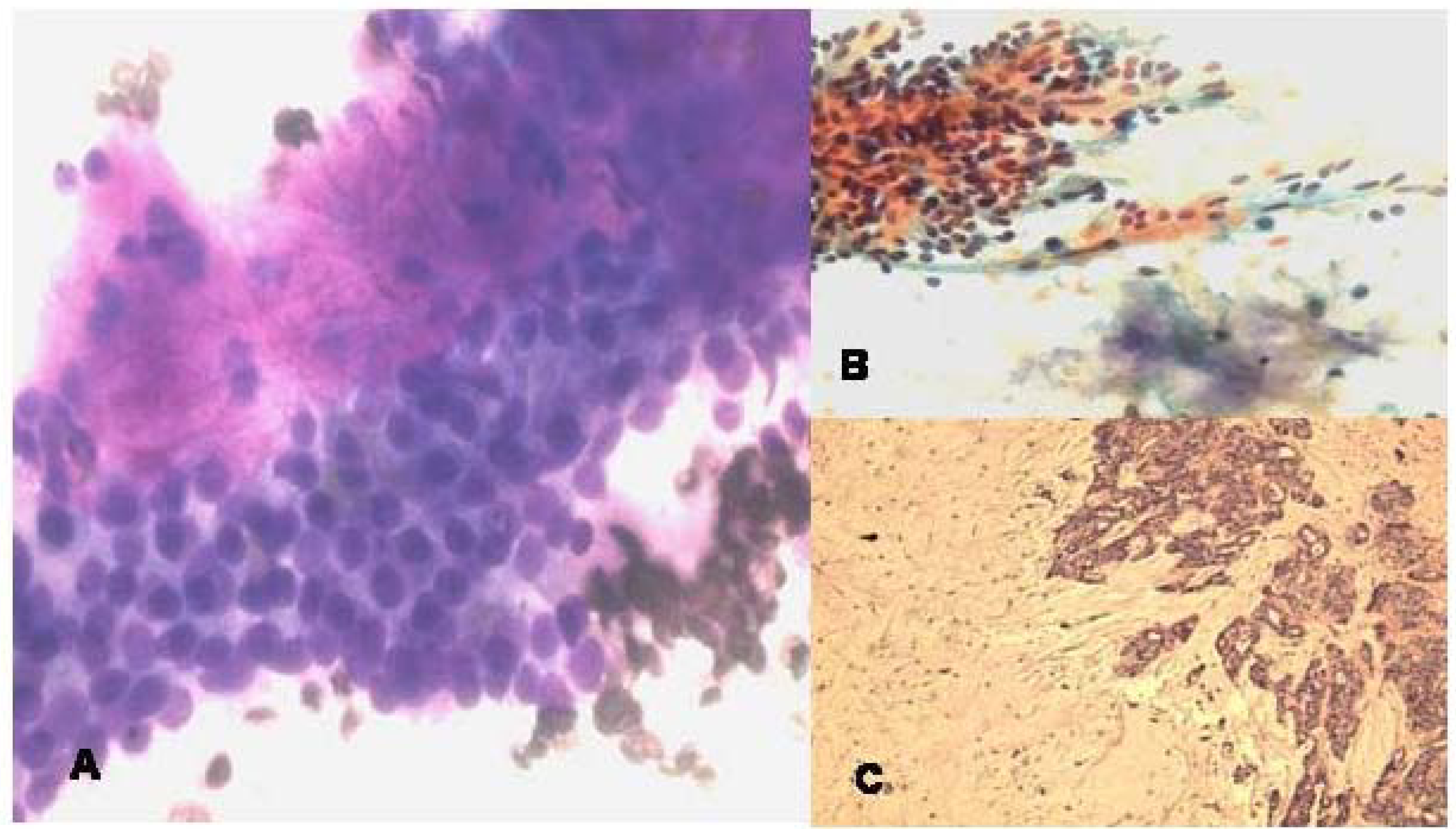 a. FNA smear of minor salivary gland pleomorphic adenoma showing cohesive cluster of uniform low grade epithelial cells with admixed metachromatic myxoid fibrillary stroma and few spindle cells (Diff-Quik, ×400).b. FNA smear of pleomorphic adenoma showing group of bland uniform epithelial cells and pale fibrillary stroma and few stromal cells (Papanicolaou stain, ×200). c. Histologically, islands of epithelial cords and glands and abundant myxoid fibrillary stroma. (Hematoxylin & Eosin, ×100).