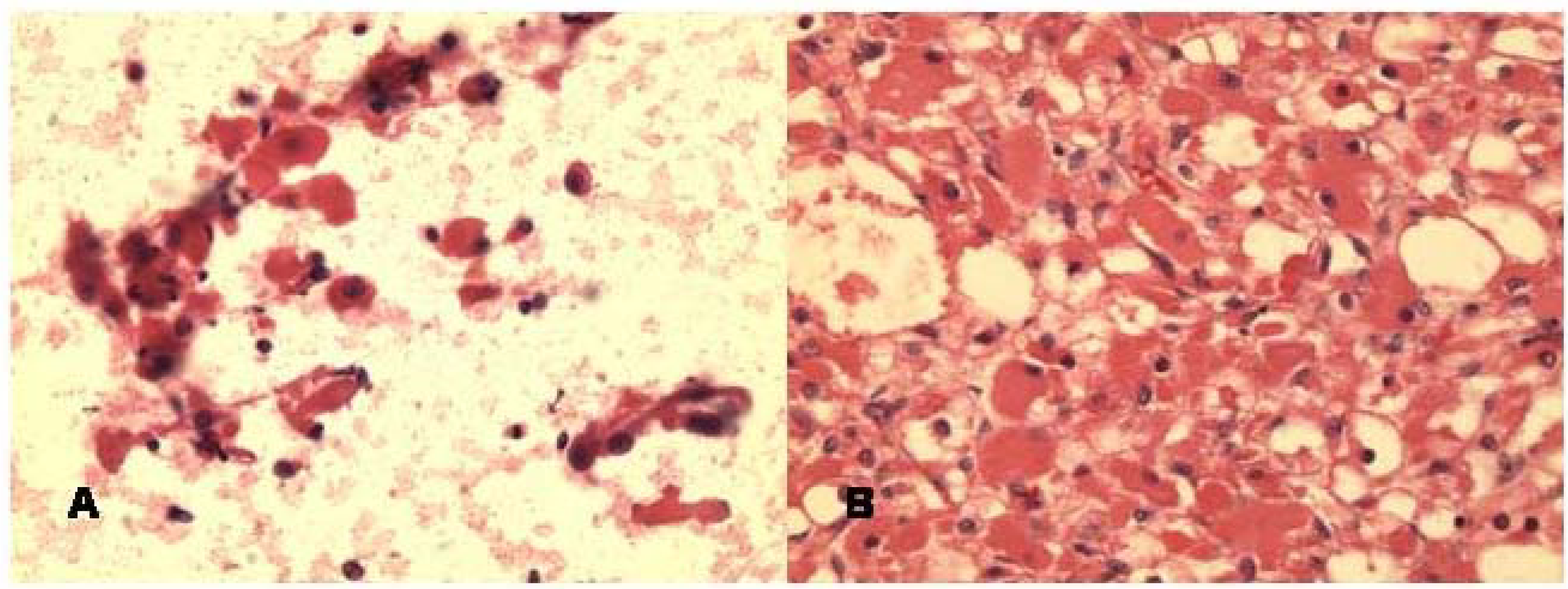 a. FNA smear of adult rhabdomyoma of right peripharyngeal mass showing loose clusters and single large polygonal cells with abundant reddish cytoplasm and round nuclei. Some cells have peripheral nuclei. (Hematoxylin & Eosin, ×400).b. Histologically, the tumor show diffuse sheets of large cells with abundant reddish cytoplasm and peripheral nuclei (Hematoxylin & Eosin, ×100).