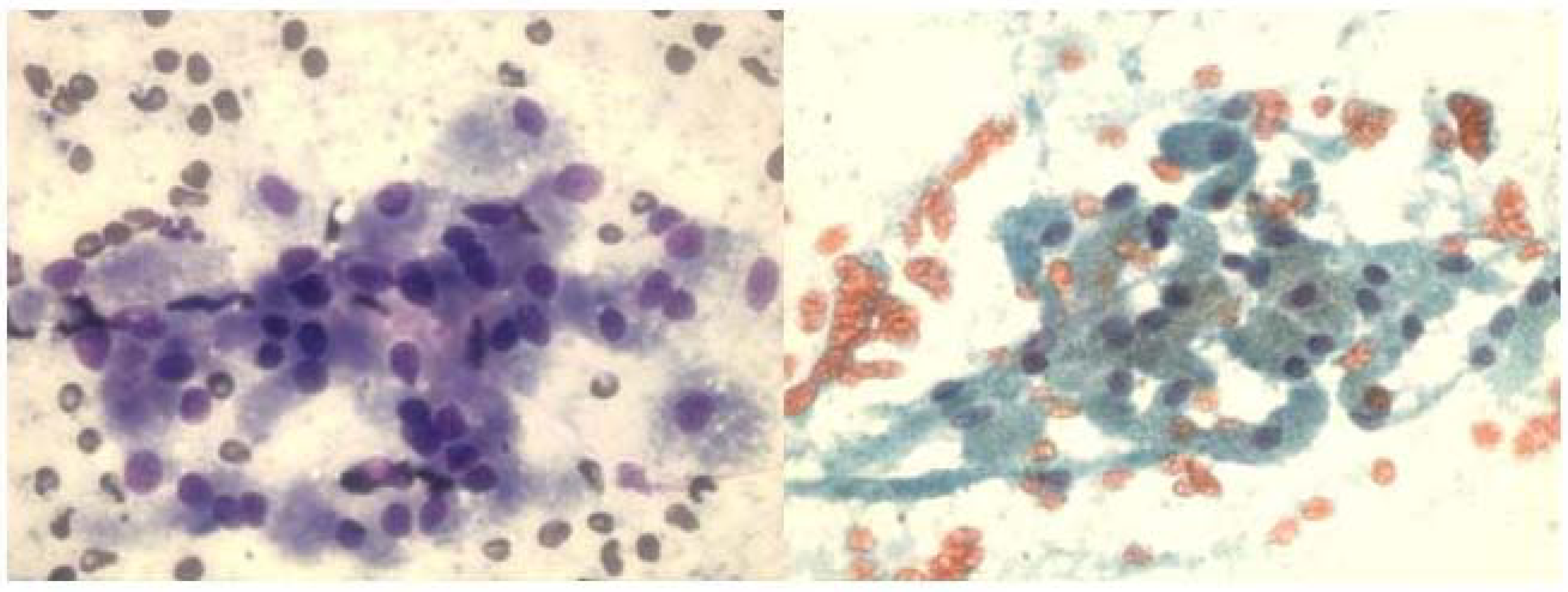 a and b. FNA smears of granular cell tumor displaying discohesive clusters of uniform large cells with abundant granular cytoplasm and central round bland nuclei. (a, Diff-Quik, ×400;b, Papanicolaou satin, ×400).