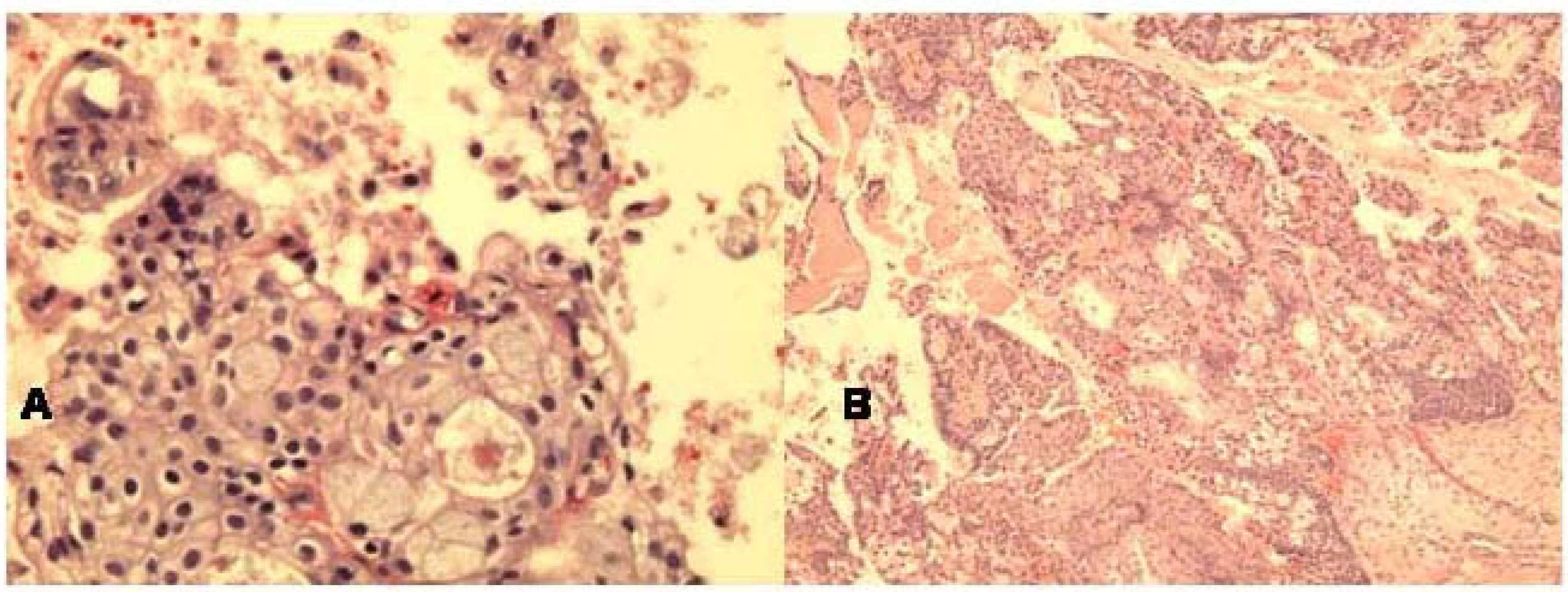 a. Cell block section of low grade mucoepidermoid carcinoma displaying nested squamous cells and glandular cells forming gland with goblet cells (Hematoxylin & Eosin, ×400).b. Histologically, solid and cystic tumor growth pattern with islands of squamous cells and glandular elements (Hematoxylin & Eosin, ×100).