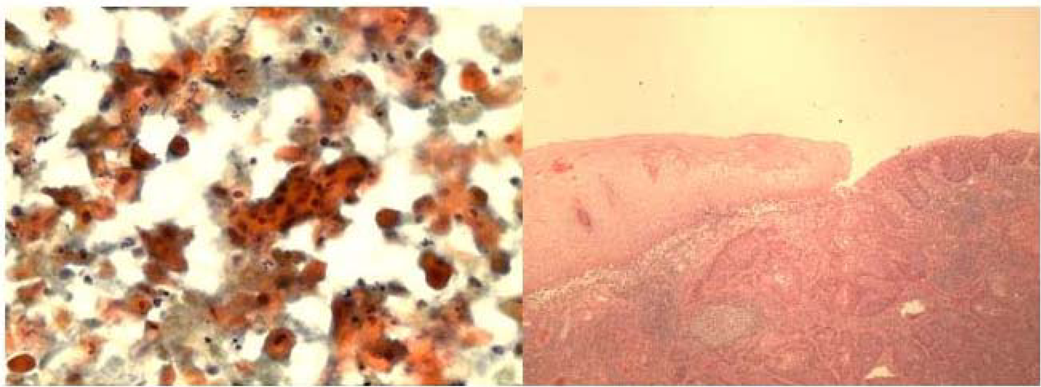 a. FNA smear showing discohesive clusters and single pleomorphic atypical malignant squamous cells with very hyperchromatic nuclei (Papanicolaou stain, ×400).b. Histologically, invasive islands of squamous carcinoma adjacent to normal squamous mucosa (Hematoxylin & Eosin, ×40).