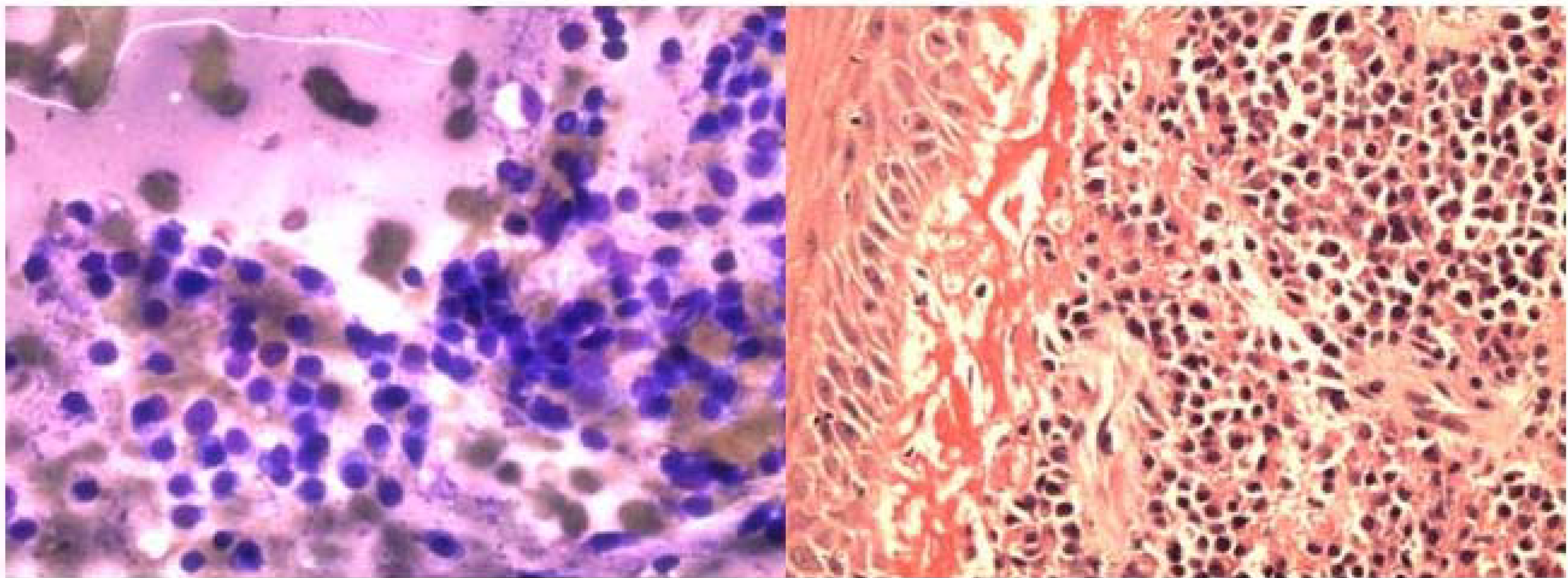 a. FNA smear of plasmacytoma showing monolayer singly dispersed plasma cell. (Diff-Quik stain, ×400).b. Histologically, diffuse proliferation of atypical plasma cells with overlying benign squamous mucosa (Hematoxylin & Eosin, ×100).