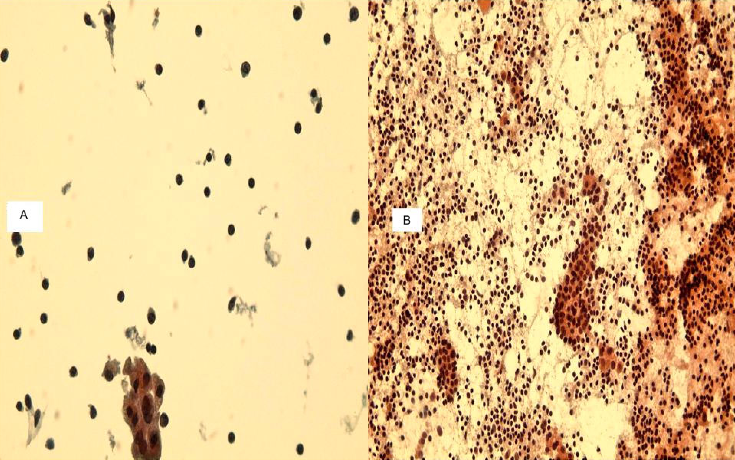 a. A TP slide of chronic thyroiditis of thyroid FNA showing many lymphocytes and scattered plasma cells, group of follicular cells and no colloid. b. The traditional smear of the same case displaying many lymphocytes, plasma cells and groups of reactive follicular cells. No colloid. (400×, Papanicolaou stain).