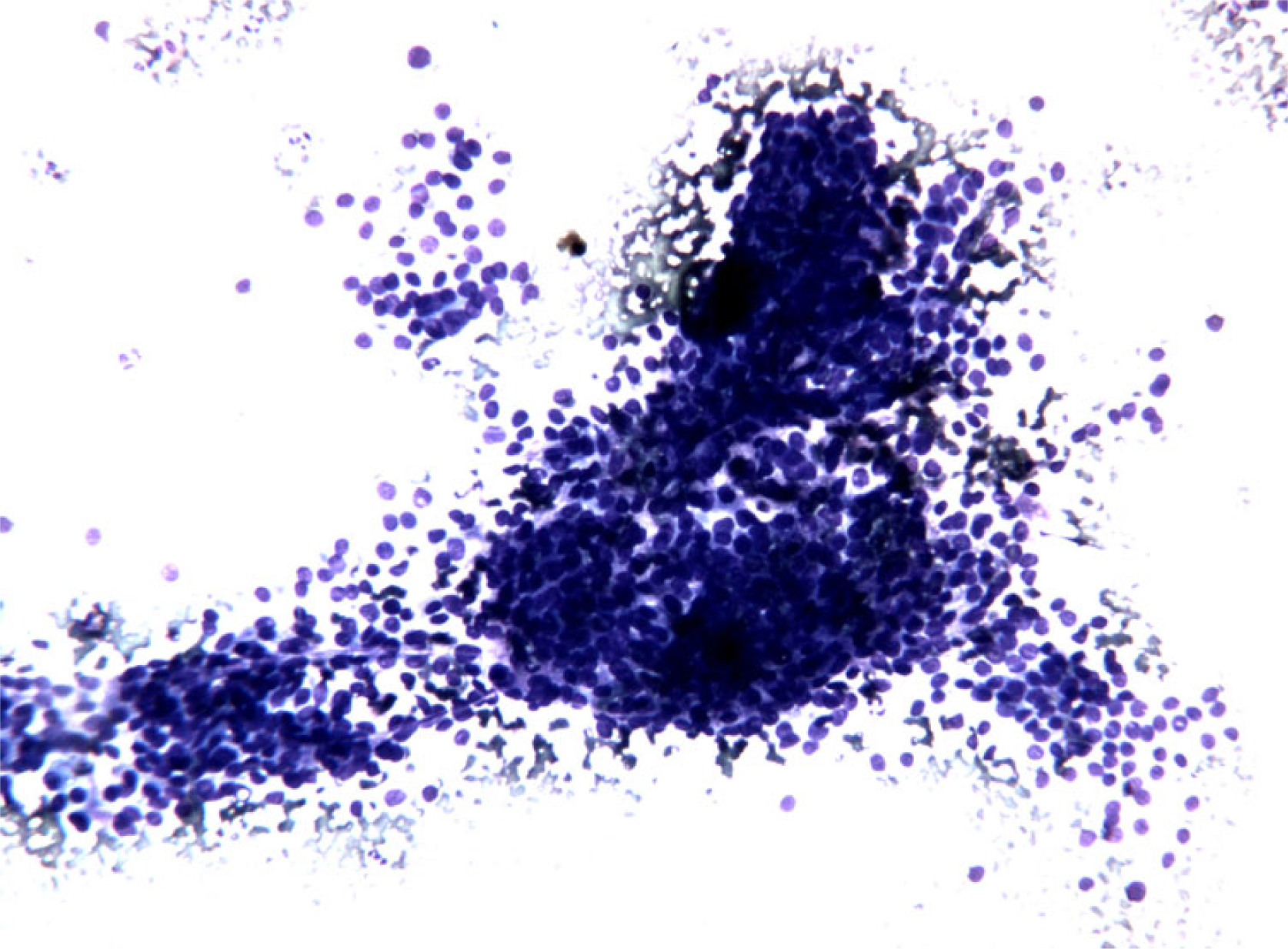 FNC sample of a solid variant of PTC. Microscopic field containing monolayered epithelial cellular sheets. Note the occurrence of nuclar overlapping and crowding and also of a certain degree of variability in cellular shape and size with anisocytosis and anisonucleosis. (Diff-Quick® staining 10×)