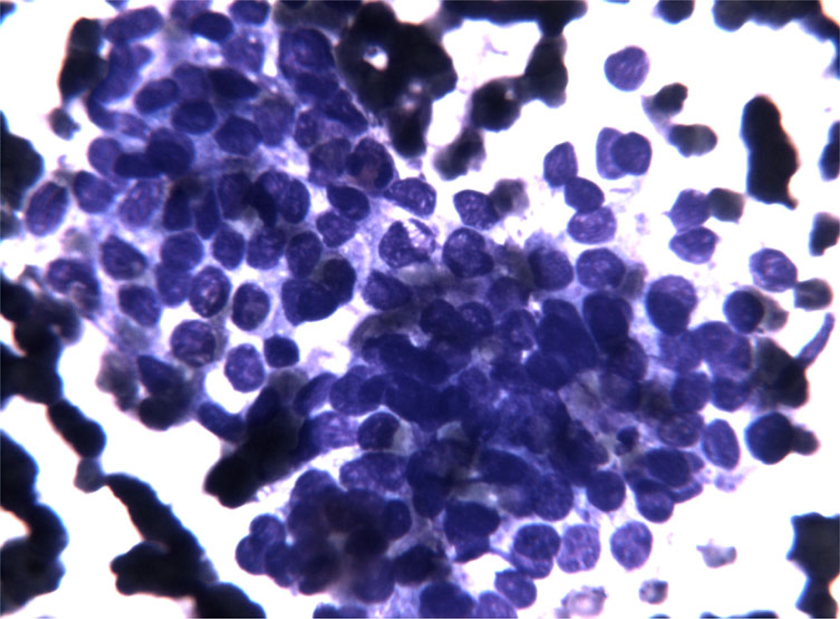 FNC sample of a solid variant of PTC. At higher magnification note the presence of enlarged nuclei with fine chromatin, with occasional nuclear grooves and micronucleoli. These changes prompted the performance of a second pass to perform BRAF molecular analysis. (Diff-Quick® staining 40×)