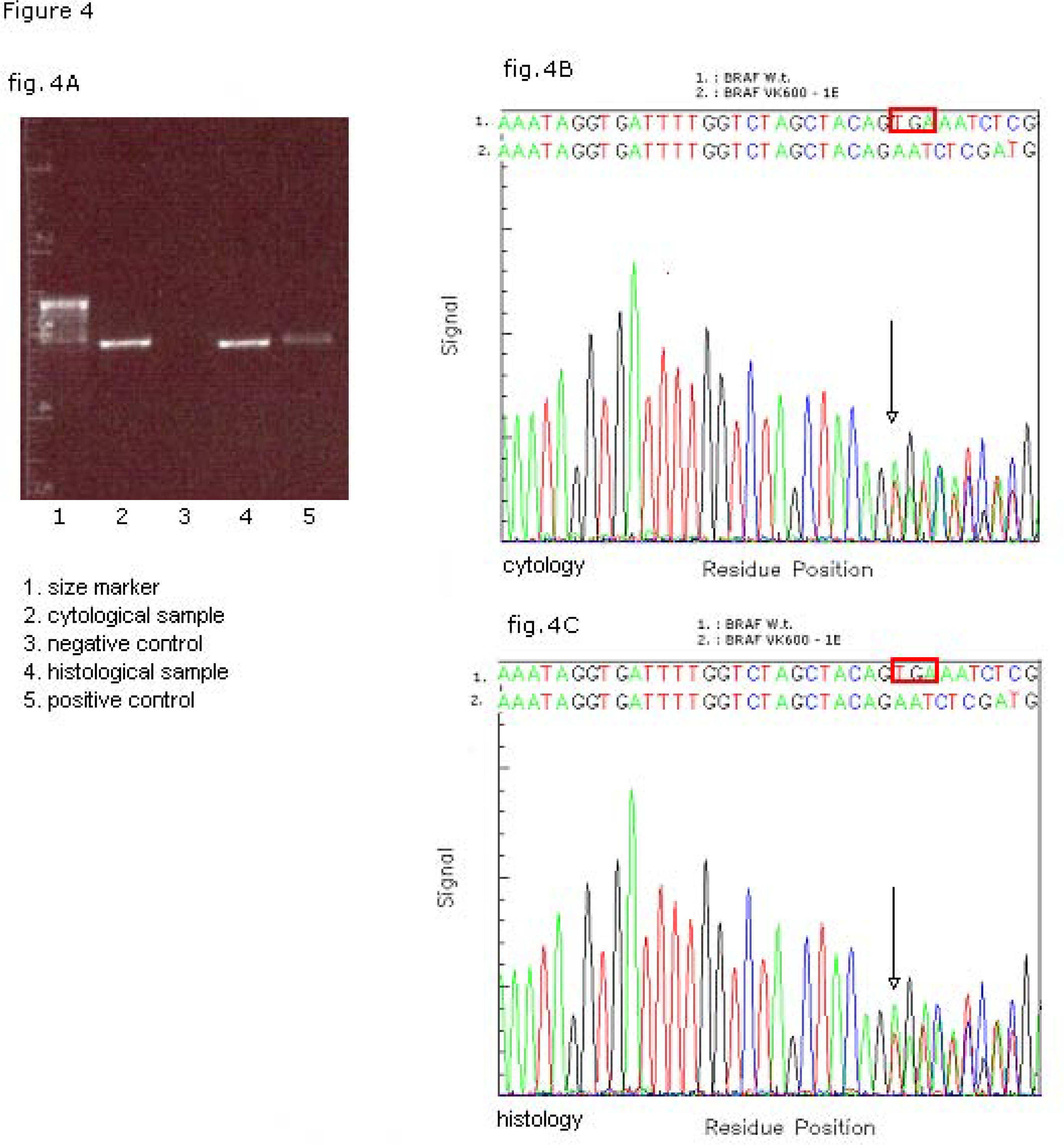 Molecular analysis of BRAF mutational status on matched cyto-histological samples. Electrophoresys of the PCR product of BRAF exon (A). Sequencing profile/fluorograph of the matched cytological (B) and histological (C) samples with the respective nucleotide (Nt) sequences of WT (1 BRAFWT) and mutated (2 BRAFVK600–1E) alleles. The box red in wild-type sequence shows the deleted nucleotide triplet TGA 1799 – 1801.